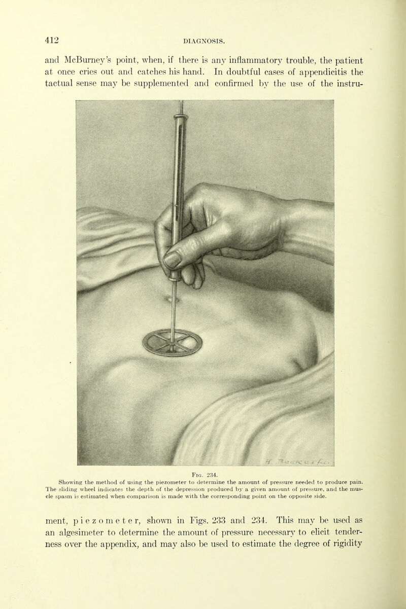 and McBurney's point, when, if there is any inflammatory trouble, the patient at once cries out and catches his hand. In doubtful cases of appendicitis the tactual sense may be supplemented and confirmed by the use of the instru- FiG. 234. Showing the method of using the piezometer to determine the amount of pressure needed to produce pain. The sHding wheel indicates the depth of the depression produced by a given amount of pressure, and the mus- cle spasm is estimated when comparison is made with the corresponding point on the opposite side. ment, piezometer, shown in Figs. 233 and 234. This may be used as an algesimeter to determine the amount of pressure necessary to elicit tender- ness over the appendix, and may also be used to estimate the degree of rigidity