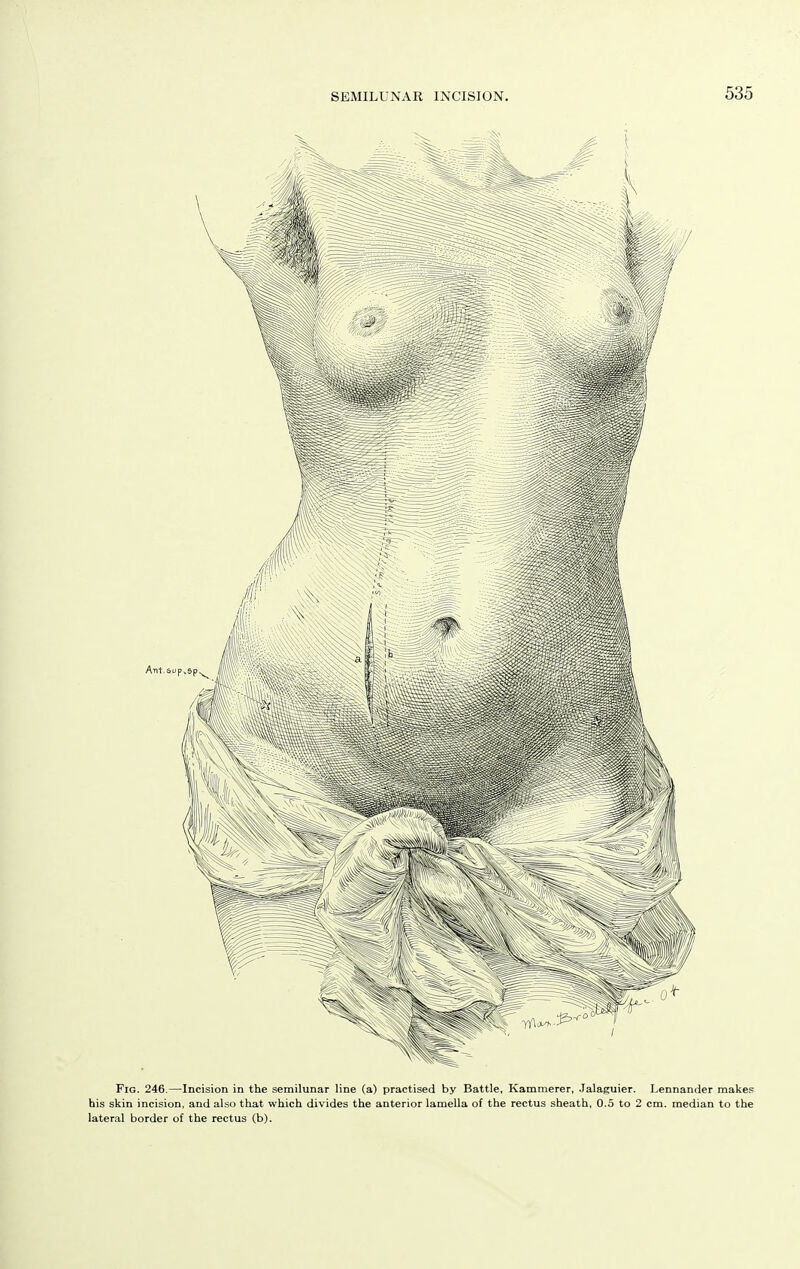 Fig. 246.—Incision in the semilunar line (a) practised by Battle, Kammerer, .Jalaguier. Lennander makes his skin incision, and also that which divides the anterior lamella of the rectus sheath, 0.5 to 2 cm. median to the lateral border of the rectus (b).