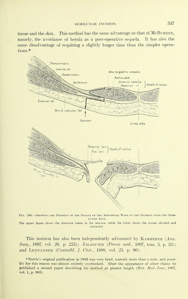 tissue and the skin. This method has the same advantage as that of McBurney, namely, the avoidance of hernia as a post-operative sequela. It has also the same disadvantage of requiring a slightly longer time than the simpler opera- tions.* Incision Linea alba Fig. 248.—Showing the Division of the Strata of the Abdominal Wall in the Incision over the Semi- lunar Line. The upper figure shows the direction taken in the incision, while the lower shows the tissues divided and retracted. This incision has also been independenth' advocated by Kammerer (Ann. Surg., 1897, vol. 26, p. 225); Jal.^guier {Pre.sse med., 1897, tom. 5, p. 53); and Lennander (Centralbl. f. Chir., 1898, vol. 25, p. 90). * Battle's original publication in 1895 was very brief, scarcely more than a note, and possi- bly for this reason was almost entirely overlooked. After the appearance of other claims he published a second paper describing his method at greater length {Brit. Med. Jour., 1897, vol. 1, p. 965).