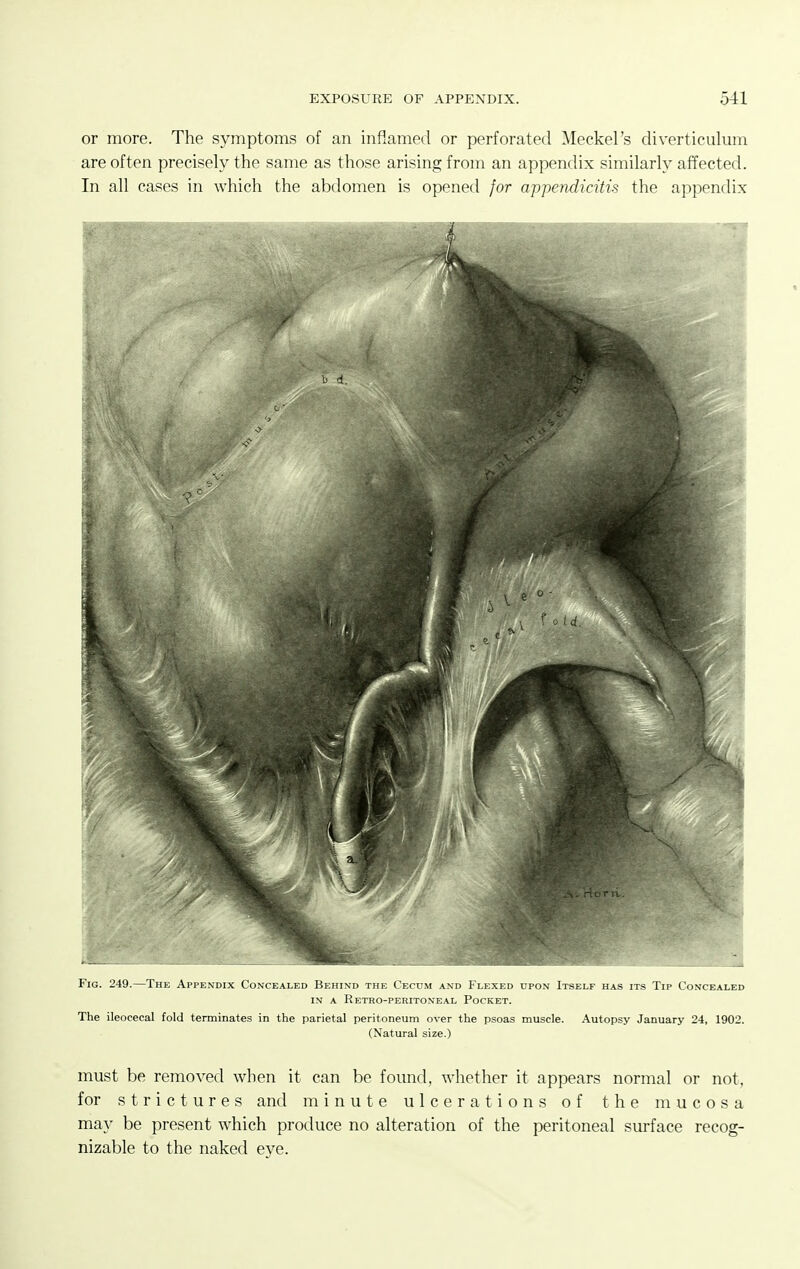 or more. The symptoms of an inflamed or perforated Meckel's diverticulum are often precisely the same as those arising from an appendix similarly affected. In all cases in which the abdomen is opened for appendicitis the appendix Fig. 249.—The Appendix Concealed Behind the ('Err.M and Flexed upon Itself has its Tip Concealed IN A Retro-peritoneal Pocket. The ileocecal fold terminates in the parietal peritoneum over the psoas muscle. Autopsy January 24, 1902. (Natural size.) must be removed when it can be found, whether it appears normal or not, for strictures and minute ulcerations of the mucosa may be present which produce no alteration of the peritoneal surface recog- nizable to the naked eye.