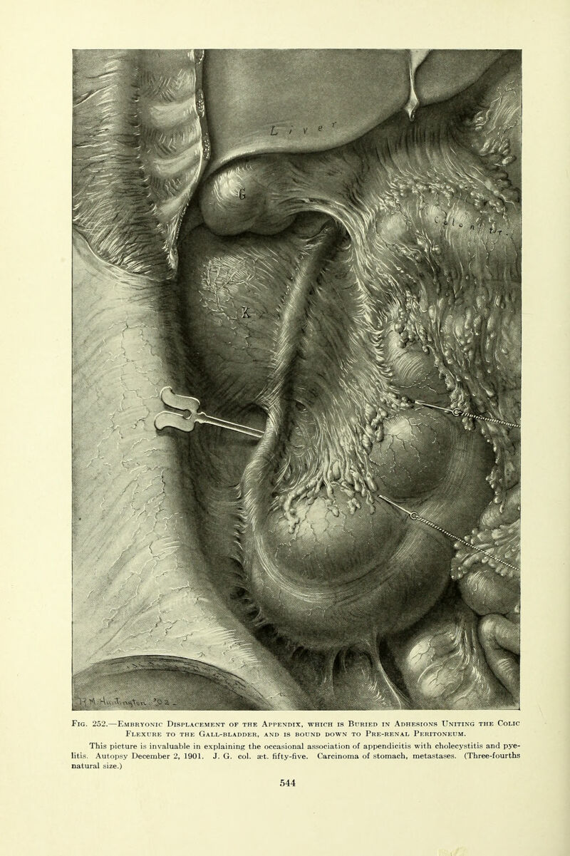 Fig. 252.—Embryonic Displacement op the Appendix, which is Buried in Adhesions Uniting the Colic Flexure to the Gall-bladder, and is bound down to Pre-renal Peritoneum. This picture is invaluable in explaining the occasional association of appendicitis with cholecystitis and pye- litis. Autopsy December 2, 1901. J. G. col. ast. fifty-five. Carcinoma of stomach, metastases. (Three-fourths natural size.)