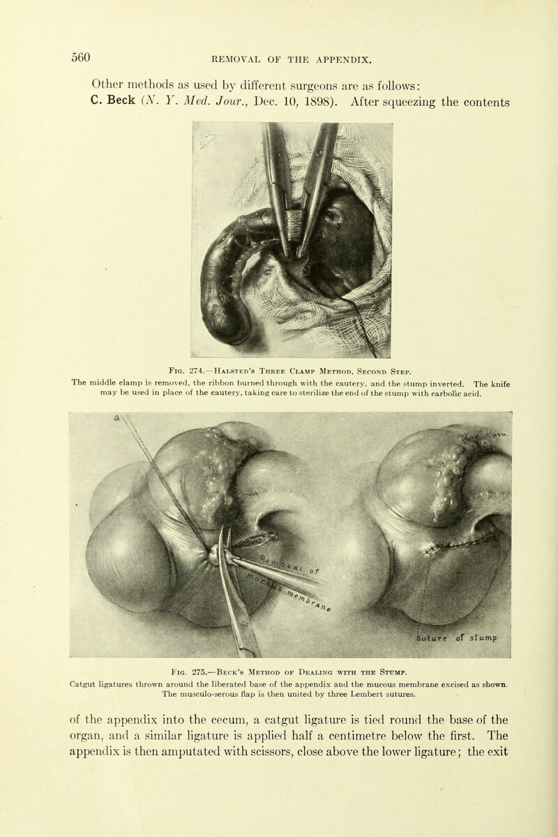 Other methods as used by different surgeons are as follows: C. Beck (N. Y. Med. Jour., Dec. 10, 1898). After squeezing the contents Fig. 274.—Halsted's Three Clamp Method, SsroND Step. The middle clamp is removed, the ribbon burned through with the cautery, and the stump inverted. The knife may be used in place of the cautery, taking care to sterilize the end of the stump with carbolic acid. Fig. 275.—Beck's Method of Dealing with the Stump. Catgut ligatures thrown around the liberated base of the appendix and the mucous membrane excised as shown. The musculo-serous flap is then united by three Lembert sutures. of the appendix into the cecum, a catgut ligature is tied round the base of the organ, and a similar ligature is applied half a centimetre below the first. The appendix is then amputated with scissors, close above the lower ligature; the exit