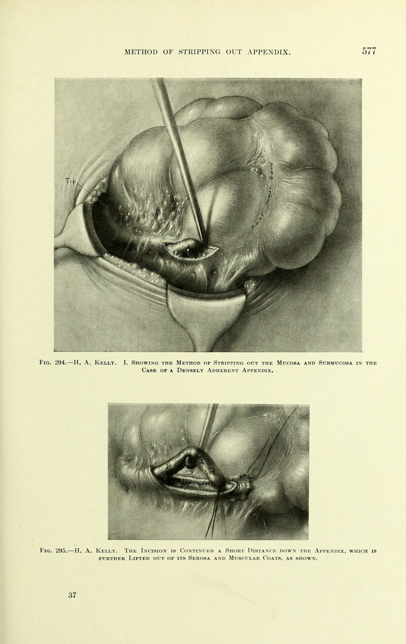 Fig. 294.—H. A. Kelly. I. Showing the Method of Stripping ottt the Mucosa and Submdcosa in the Case of a Densely Adherent Appendix. Fig. 295.—H. A. Kelly. The Incision is I'ontim i:!) a Short Distance down the Appendix, which is further Lifted out of its Serosa and Muscular Coats, as shown. 37