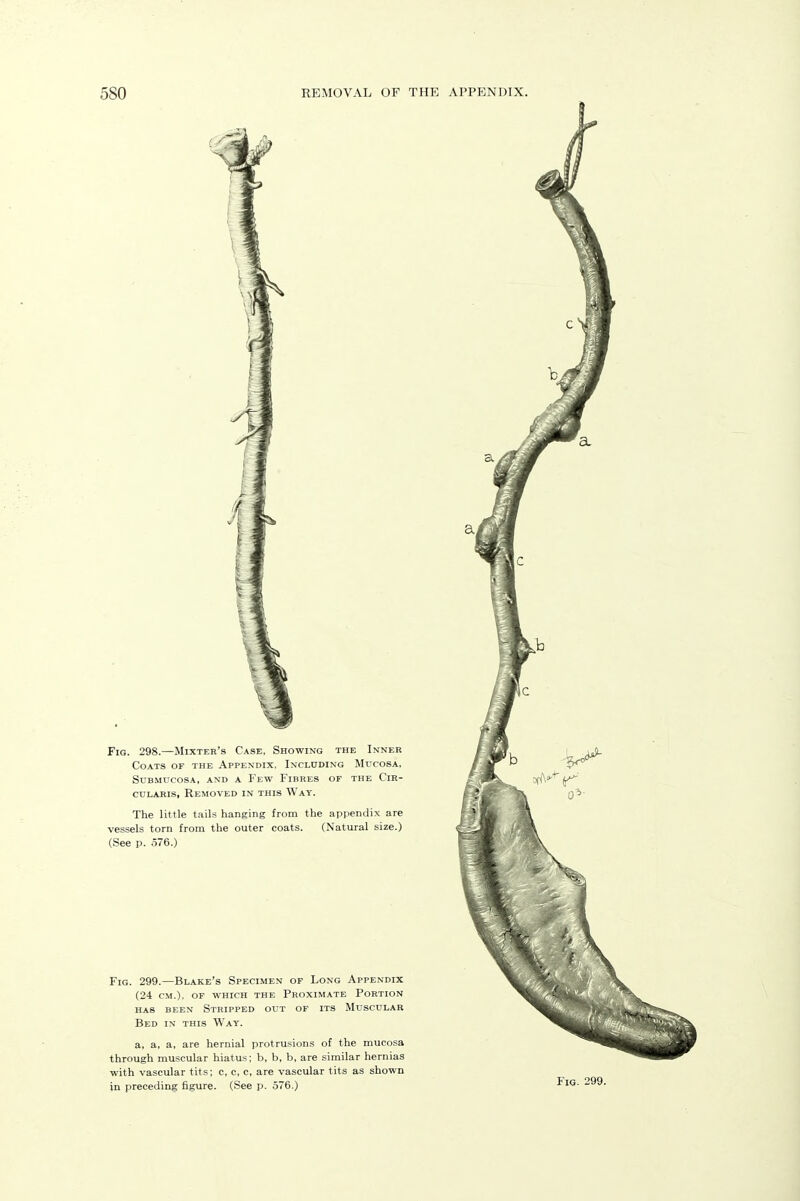 a Fig. 298.—Mixter's Case, Showing the Inner Coats of the Appendix. Including Mucosa, SUBMUCOSA, AND A FeW FiBRES OF THE ClE- cuLAKis, Removed in this Way. The little tails hanging from the appendix are vessels torn from the outer coats. (Natural size.) (See p. 576.) Fig. 299.—Blake's Specimen of Long Appendix (24 cm.), of which the proximate portion HAS BEEN Stripped out of its Muscular Bed in this Way. a, a, a, are hernial protrusions of the mucosa through muscular hiatus; b, b, b, are similar hernias with vascular tits; c, c, c, are vascular tits as shown in preceding figure. (See p. 576.)