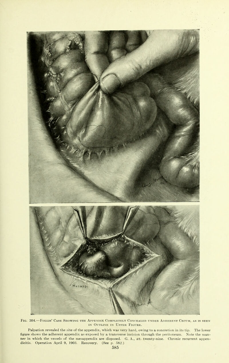 Fig. 304.—Follis' Case Showing the Appendix Completely Concealed under Adherfznt Cecfm, as is see.v IN OuTLi.NE IN Upper Figure. Palpation revealed the site of the appendix, which was very hard, owing to a concretion in its tip. The lower figure shows the adherent appendix as exposed by a transverse incision through the peritoneum. Note the man- ner in which the vessels of the mesappendix are disposed. G. A., set. twenty-nine. Chronic recurrent appen- dicitis. Operation April 9, 1903. Recovery. (See p. 582.)