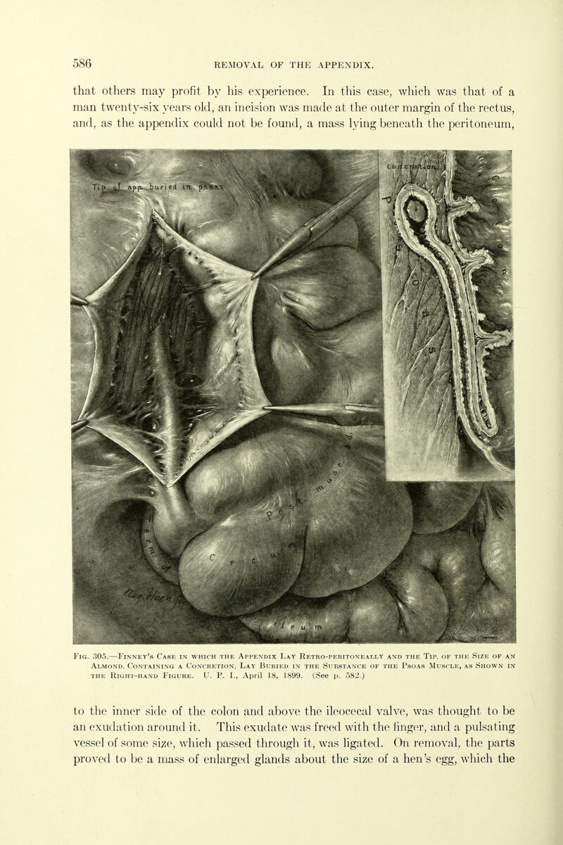 that others may profit by his experience. In this case, which was that of a man twenty-six years old, an incision was made at the outer margin of the rectus, and, as the appendix could not be found, a mass lying beneath the peritoneum, Fig. 305.—Finney's Case in which the Appendix Lay Retro-peritoneally and the Tip. of the Size of an Almond, Containing a Concretion, Lay Buried in the Substance of the Psoas Muscle, as Shown in THE Right-hand Figure. U. P. 1., April 18, 1899. (See p. 582.) to the inner side of the colon and above the ileocecal valve, was thought to be an exudation around it. This exudate was freed with the finger, and a pulsating vessel of some si^e, which passed through it, was ligated. On removal, the parts proved to be a mass of enlarged glands about the size of a hen's egg, which the