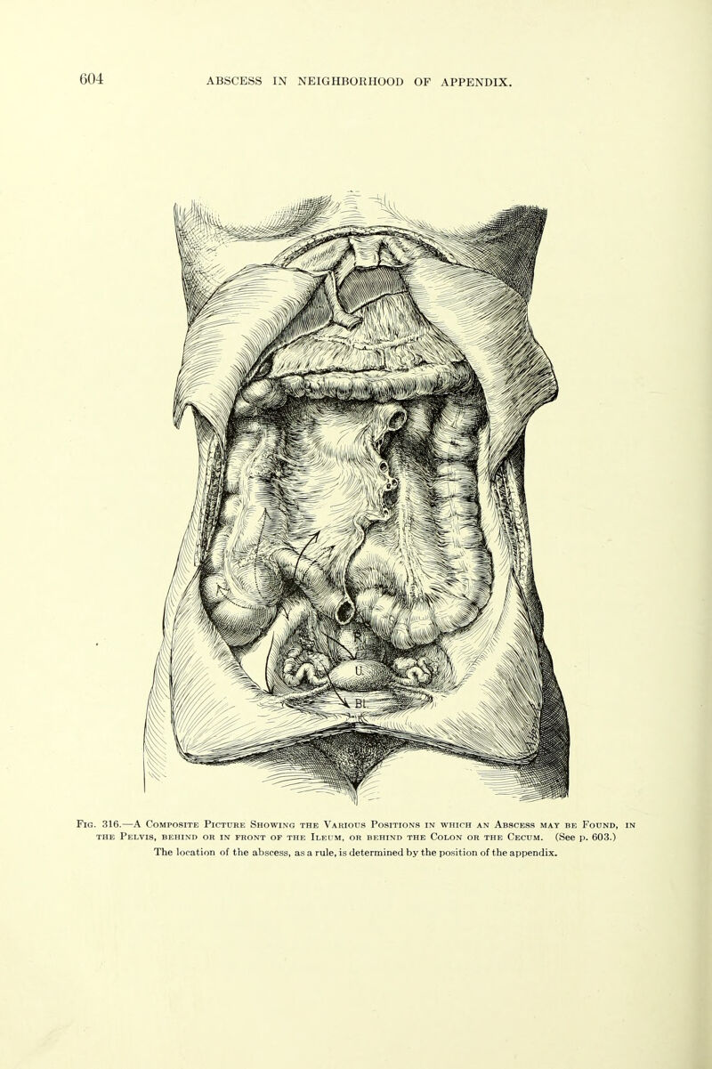 Fig. 316.—A Composite Picture Showing the Various Positions in which an Abscess may be Found, in THE Pelvis, behind or in front op the Ileum, or behind the Colon or the Cecum. (See p. 603.) The location of the abscess, as a rule, is determined by the position of the appendix.