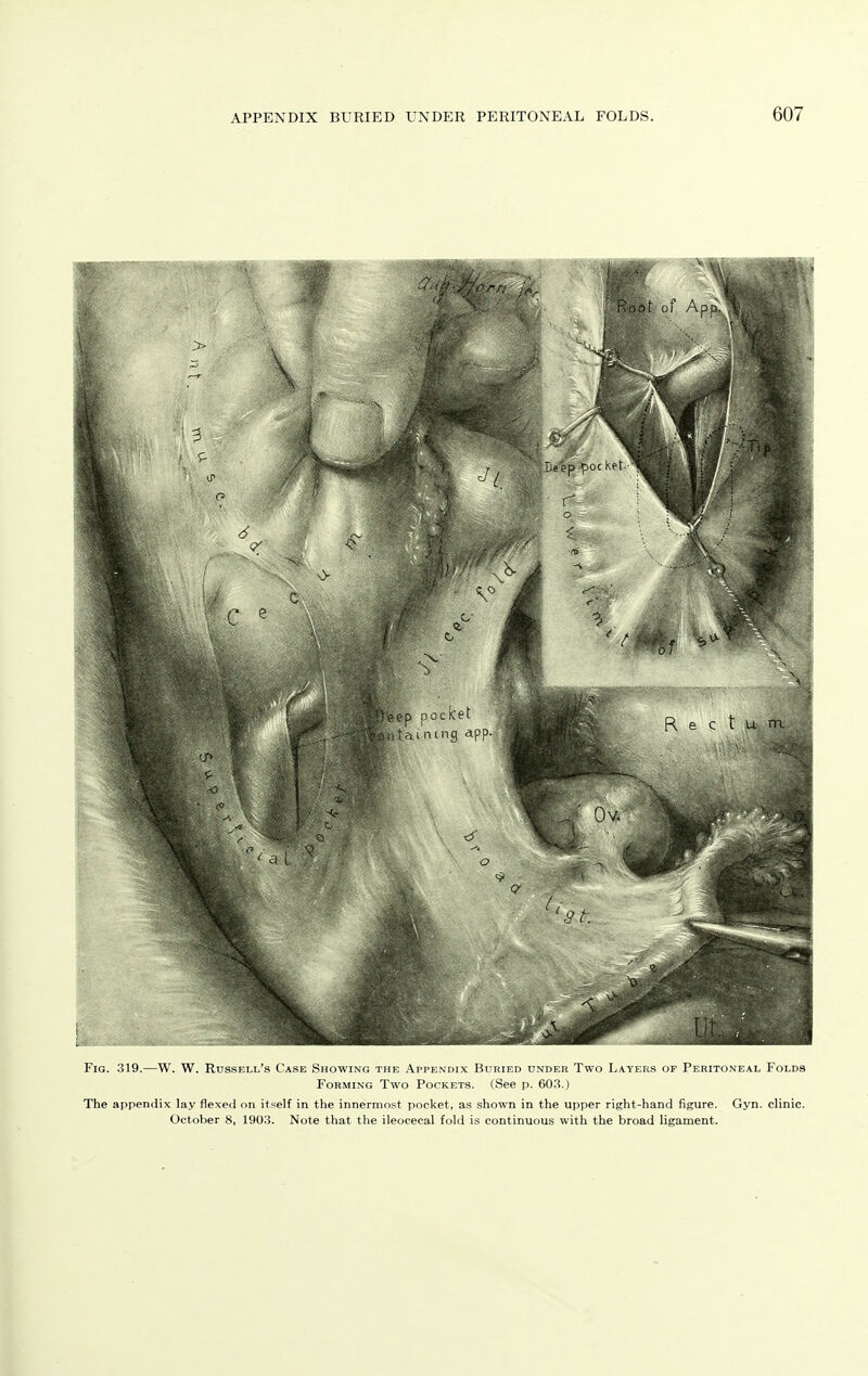 Fig. 319.—VV. W. Russeli/s Case Showing the Appendix Buried under Two Layers of Peritoneal Folds Forming Two Pockets. (See p. 603.) The appendix lay flexed on itself in the innermost pocket, as shown in the upper risht-hand figure. Gyn. clinic. October 8, 1903. Note that the ileocecal fold is continuous with the broad ligament.