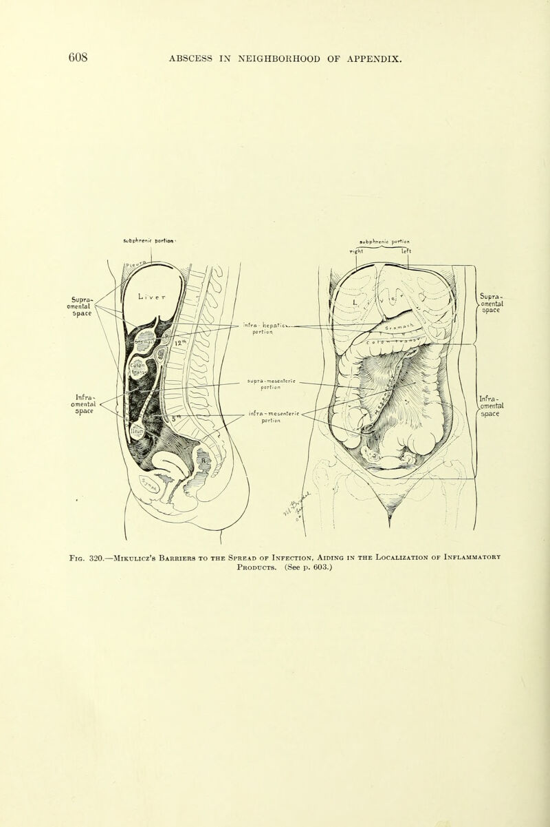 Fig. 320.—Mikulicz's Barriers to the Spread of Infection, Aiding in the Localization of Inflammatory Products. (See p. 603.)