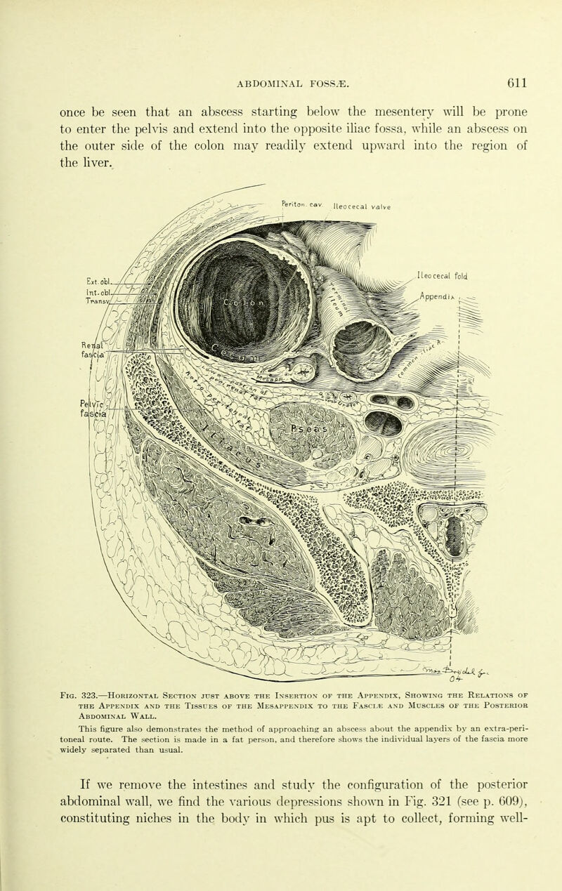 once be seen that an abscess starting below the mesentery will be prone to enter the peh'is and extend into the opposite iliac fossa, while an abscess on the outer side of the colon may readily extend upward into the region of the liver. Fig. 323.—Horizontal Section just above the Insertion of the Appendix, Showing the Relations of THE Appendix and the Tissues of the Mesappendix to the Fasci.e and Muscles of the Posterior Abdominal Wall. This figure also demonstrates the method of approaching an abscess about the appendix by an extra-peri- toneal route. The section is made in a fat person, and therefore shows the individual layers of the fascia more widely separated than usual. If we remove the intestine? and study the configuration of the posterior abdominal wall, we find the various depressions shown in Fig. 321 (see p. 609), constituting niches in the body in which pus is apt to collect, forming well-