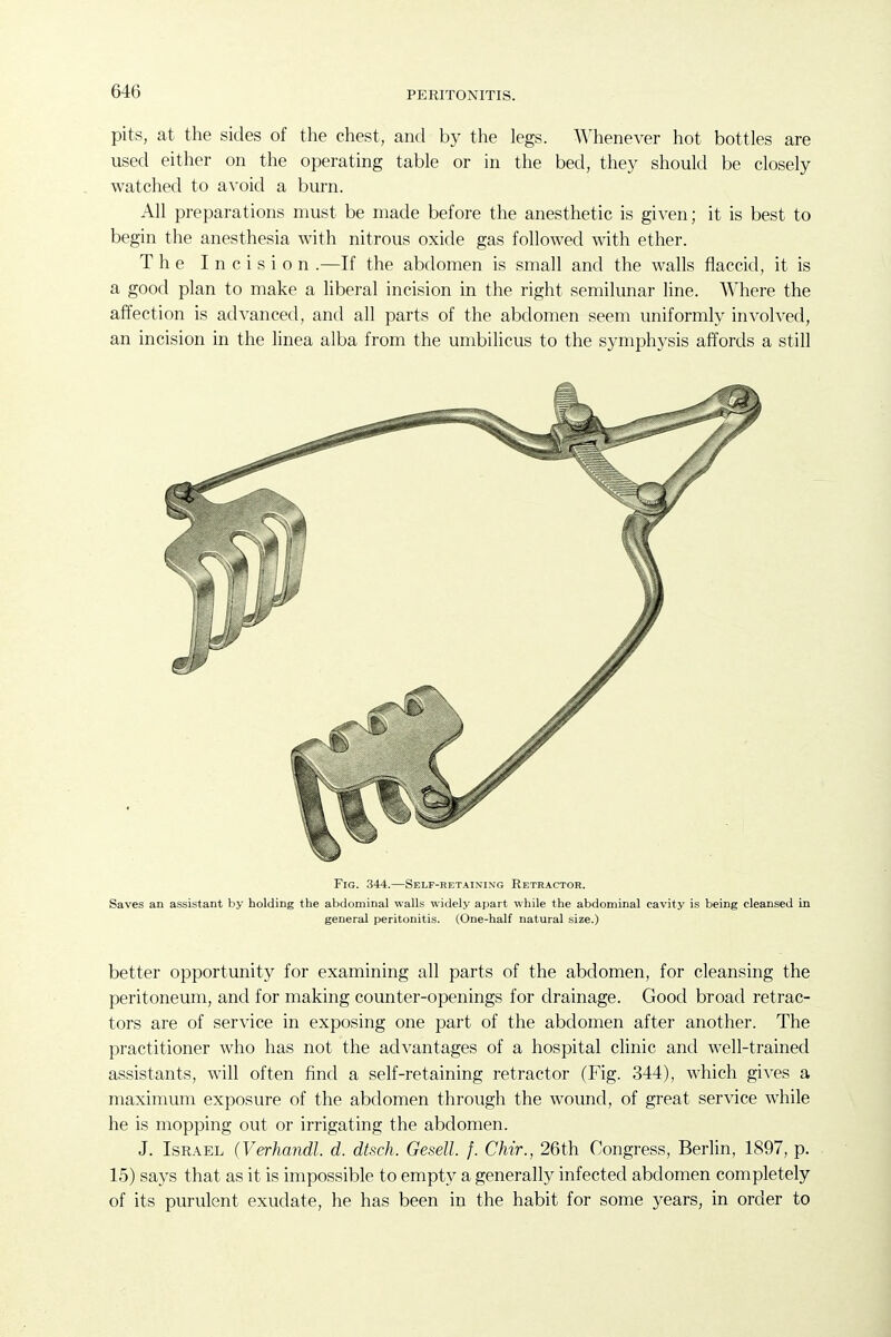 pits, at the sides of tlie chest, and by the legs. Whenever hot bottles are used either on the operating table or in the bed, they should be closely watched to avoid a burn. All preparations must be made before the anesthetic is given; it is best to begin the anesthesia with nitrous oxide gas followed with ether. The Incision .—If the abdomen is small and the walls flaccid, it is a good plan to make a liberal incision in the right semilunar line. Where the affection is advanced, and all parts of the abdomen seem uniformly involved, an incision in the linea alba from the umbilicus to the symphysis affords a still Fig. 344.—Self-retaining Retractor. Saves an assistant by holding the abdominal walls widely apart while the abdominal cavity is being cleansed in general peritonitis. (One-half natural size.) better opportunity for examining all parts of the abdomen, for cleansing the peritoneum, and for making counter-openings for drainage. Good broad retrac- tors are of service in exposing one part of the abdomen after another. The practitioner who has not the advantages of a hospital clinic and well-trained assistants, will often find a self-retaining retractor (Fig. 344), which gives a maximum exposure of the abdomen through the wound, of great service while he is mopping out or irrigating the abdomen. J. Israel (Verhandl. d. dtsch. Gesell. f. Chir., 26th Congress, Berlin, 1897, p. 15) says that as it is impossible to empty a generally infected abdomen completely of its purvilent exudate, he has been in the habit for some years, in order to