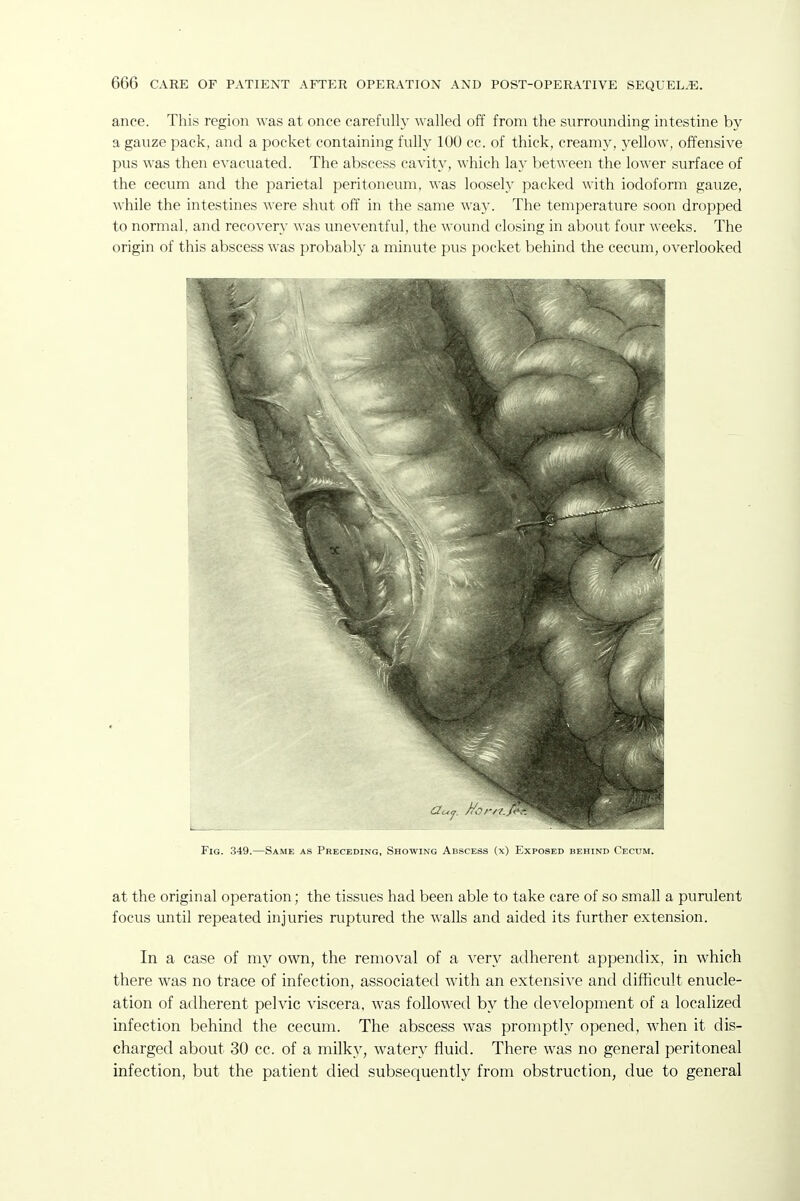 ance. This region was at once carefully walled off from the surrounding intestine by a gauze pack, and a pocket containing fully 100 cc. of thick, creamy, yellow, offensive pus was then e^'acuated. The abscess cavity, which lay bet^^■een the lower surface of the cecum and the parietal peritoneum, was loosely packed with iodoform gauze, while the intestines were shut off in the same way. The temperature soon dropped to normal, and recovery was uneventful, the wound closing in about four weeks. The origin of this abscess was probably a minute pus pocket behind the cecum, overlooked Fig. 349.—Same as Preceding, Showing Abscess (x) Exposed behind Cecum. at the original operation; the tissues had been able to take care of so small a purulent focus until repeated injuries ruptured the walls and aided its further extension. In a case of my own, the removal of a very adherent appendix, in which there was no trace of infection, associated with an extensive and difficult enucle- ation of adherent pelvic viscera, was followed by the development of a localized infection behind the cecum. The abscess was promptly opened, when it dis- charged about 30 cc. of a milky, watery fluid. There was no general peritoneal infection, but the patient died subsequently from obstruction, due to general