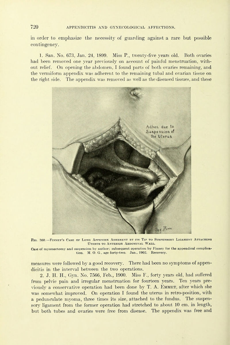 ill order to emphasize tlie necessity of guarding against a rare but possible contingency. 1. San. No. 673, Jan. 24, 1899. Miss P., twenty-five years old. Both ovaries had been removed one year previously on account of painful menstruation, with- out relief. On opening the abdomen, I found parts of both ovaries remaining, and the vermiform appendix was adherent to the remaining tubal and ovarian tissue on the right side. The appendix was removed as well as the diseased tissues, and these Fig. 360.—Finney's Case of Long Appendix Adherent by its Tip to Suspensory Ligament Attaching Uterus to Anterior Abdominal Wall. Case of myomectomy and suspension by author; subsequent operation by Finney for the appendical complica- tion. M. O. G., age forty-two. Jan., 1902. Recovery. measures were followed by a good recovery. There had been no symptoms of appen- dicitis in the interval between the two operations. 2. J. H. H., Gyn. No. 7566, Feb., 1900. Miss F., forty years old, had suffered from pelvic pain and irregular menstruation for fourteen years. Ten years pre- viously a conservative operation had been done by T. A. Emmet, after which she was somewhat improved. On operation I found the uterus in retro-position, with a pedunculate myoma, three times its size, attached to the fundus. The suspen- sory ligament from the former operation had stretched to about 10 cm. in length, but both tubes and ovaries were free from disease. The appendix was free and