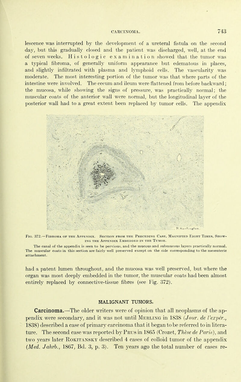 lescence was interrupted by the development of a ureteral fistula on the second day, but this gradually closed and the patient was discharged, well, at the end of seven weeks. Histologic examination showed that the tumor was a typical fibroma, of generally uniform appearance but edematous in places, and slightly infiltrated with plasma and lymphoid cells. The vascularity was moderate. The most interesting portion of the tumor was that where parts of the intestine were involved. The cecum and ileum were flattened from before backward; the mucosa, while showing the signs of pressure, was practically normal; the muscular coats of the anterior wall were normal, but the longitudinal layer of the posterior wall had to a great extent been replaced by tumor cells. The appendix (J Fig. 372.—Fibroma op the Appendix. Section from the Preceding Case, Magnified Eight Times, Show- ing THE Appendix Embedded in the Tumor. The canal of the appendix is seen to be pervious, and the mucous and submucous layers practically normal. The muscular coats in this section are fairly well preserved except on the side corresponding to the mesenteric attachment. had a patent lumen throughout, and the mucosa was well preserved, but where the organ was most deeply embedded in the tumor, the muscular coats had been almost entirely replaced by connective-tissue fibres (see Fig. 372). MALIGNANT TUMORS. Carcinoma.—^The older writers were of opinion that all neoplasms of the ap- pendix were secondary, and it was not until Merling in 1838 {Jour, de Vexper., 1838) described a case of primary carcinoma that it began to be referred to in litera- ture. The second case was reported by Prus in 1865 (Crozet, These de Paris), and two years later Rokitansky described 4 cases of colloid tumor of the appendix (Med. Jahrb., 1867, Bd. 3, p. 3). Ten years ago the total number of cases re-