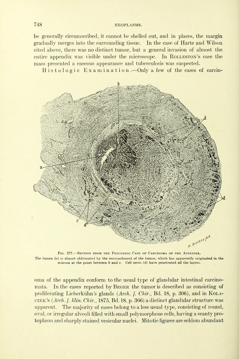 be generally circumscribed, it cannot be shelled out, and in places, the margin gradually merges into the surrounding tissue. In the case of Harte and Wilson cited above, there was no distinct tumor, but a general invasion of almost the. entire appendix was visible under the microscope. In Rolleston's case the mass presented a caseous appearance and tuberculosis was suspected. Histologic Examination .—Only a few of the cases of carcin- Fig. 377.—Section from the Preceding Case of Carcinoma of the Appendix. The lumen (a) is almost obliterated by the encroachment of the tumor, which has apparently originated in the mucosa at the point between b and c. Cell nests (d) have penetrated all the layers. oma of the appendix conform to the usual type of glandular intestinal carcino- mata. In the cases reported by Beger the tumor is described as consisting of proliferating Lieberkiihn's glands (Arch. f. Chir., Bd. 18, p. 306), and in Kola- czek's {Arch. f. klin. Chir., 1875, Bd. 18, p. 366) a distinct glandular structure was apparent. The majority of cases belong to a less usual type, consisting of round, oval, or irregular alveoli filled with small polymorphous cells, having a scanty pro- toplasm and sharply stained vesicular nuclei. Mitotic figures are seldom abundant