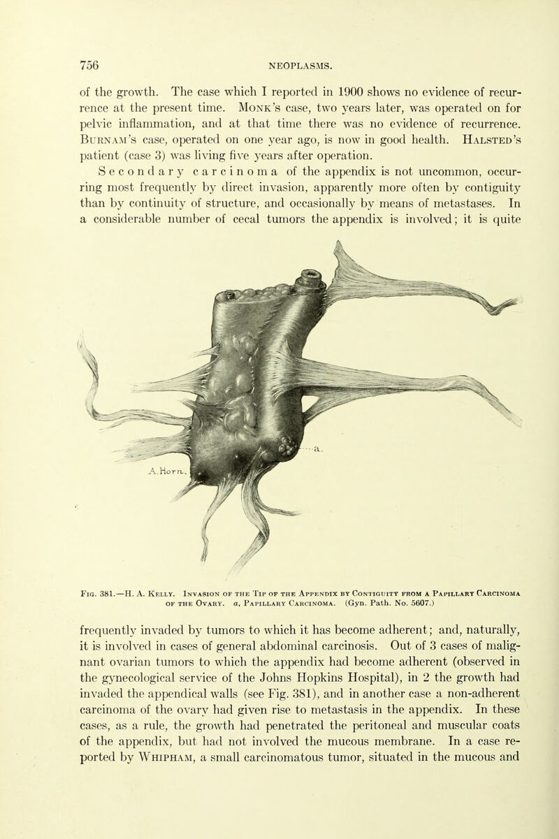 of the growth. The case which I reported in 1900 shows no evidence of recur- rence at the present time. Monk's case, two years later, was operated on for pelvic inflammation, and at that time there was no evidence of recurrence. Burn AM's case, operated on one year ago, is now in good health. Halsted's patient (case 3) was living five years after operation. Secondary carcinoma of the appendix is not uncommon, occur- ring most frequently by direct invasion, apparently more often by contiguity than by continuity of structure, and occasionally by means of metastases. In a considerable number of cecal tumors the appendix is involved; it is quite Fig. 381.—H. A. Kelly. Invasion of the Tip op the Appendix by Contiguity from a Papillary Carcinoma OF THE Ovary, a. Papillary Carcinoma. (Gyn. Path. No. 5607.) frequently invaded by tumors to which it has become adherent; and, naturally, it is involved in cases of general abdominal carcinosis. Out of 3 cases of malig- nant ovarian tumors to which the appendix had become adherent (observed in the gynecological service of the Johns Hopkins Hospital), in 2 the growth had invaded the appendical walls (see Fig. 381), and in another case a non-adherent carcinoma of the ovary had given rise to metastasis in the appendix. In these cases, as a rule, the growth had penetrated the peritoneal and muscular coats of the appendix, but had not involved the mucous membrane. In a case re- ported by Whipham, a small carcinomatous tumor, situated in the mucous and