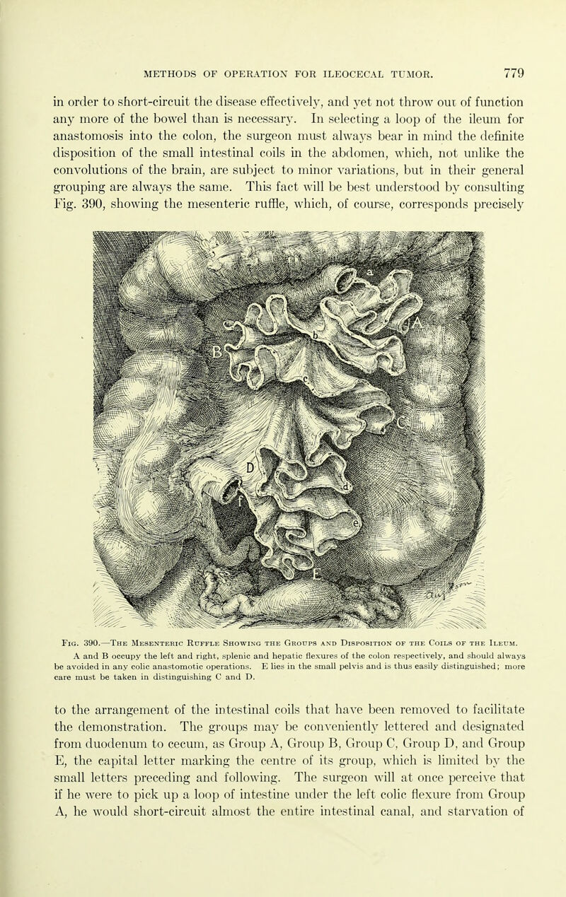 in order to short-circuit the disease effectively, and yet not throw oui of function any more of the bowel than is necessary. In selecting a loop of the ileum for anastomosis into the colon, the surgeon must always bear in mind the definite disposition of the small intestinal coils in the abdomen, which, not unlike the convolutions of the brain, are subject to minor variations, but in their general grouping are always the same. This fact will be best understood by consulting Fig. 390, showing the mesenteric ruffle, which, of course, corresponds precisely Fig. 390.—The Mesenteric Ruffle Showing the Groups and Disposition of the Coils of the Ileum. A and B occupy the left and right, splenic and hepatic flexures of the colon respectively, and should always be avoided in any colic anastomotic operations. E lies in the small pelvis and is thus easily distinguished; more care must be taken in distinguishing C and D. to the arrangement of the intestinal coils that have been removed to facilitate the demonstration. The groups may be conveniently lettered and designated from duodenum to cecum, as Group A, Group B, Group C, Group D, and Group E, the capital letter marking the centre of its group, which is limited by the small letters preceding and following. The surgeon will at once perceive that if he were to pick up a loop of intestine under the left colic flexure from Group A, he would short-circuit almost the entire intestinal canal, and starvation of