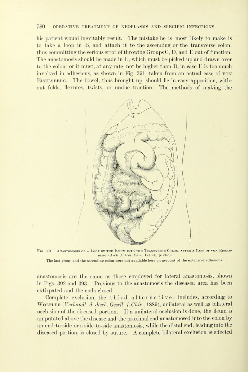 his patient would inevitably result. The mistake he is most likely to make is to take a loop in B, and attach it to the ascending or the transverse colon, thus committing the serious error of throwing Groups C, D, and E out of function. The anastomosis should be made in E, which must be picked up and drawn over to the colon; or it must, at any rate, not be higher than D, in case E is too much involved in adhesions, as shown in Fig. 391, taken from an actual case of voN EisELSBERG. The bowel, thus brought up, should lie in easy apposition, with- out folds, flexures, twists, or undue traction. The methods of making the Fig. .391.—Anastomosis of a Loop op the Ileum into the Transverse Colon, after a Case of von Eisels- BERG {Arch. f. klin. Chir., Bd. 56, p. 303). The last group and the ascending colon were not available here on account of the extensive adhesions. anastomosis are the same as those employed for lateral anastomosis, shown in Figs. 392 and 393. Previous to the anastomosis the diseased area has been extirpated and the ends closed. Complete exclusion, the third alternative, includes, according to WoLFLER (Verhandl. d. dtsch. Gesell. /. Chir., 1889), unilateral as well as bilateral occlusion of the diseased portion. If a unilateral occlusion is done, the ileum is amputated above the disease and the proximal end anastomosed into the colon by an end-to-side or a side-to-side anastomosis, while the distal end, leading into the diseased portion, is closed by suture. A complete bilateral exclusion is effected