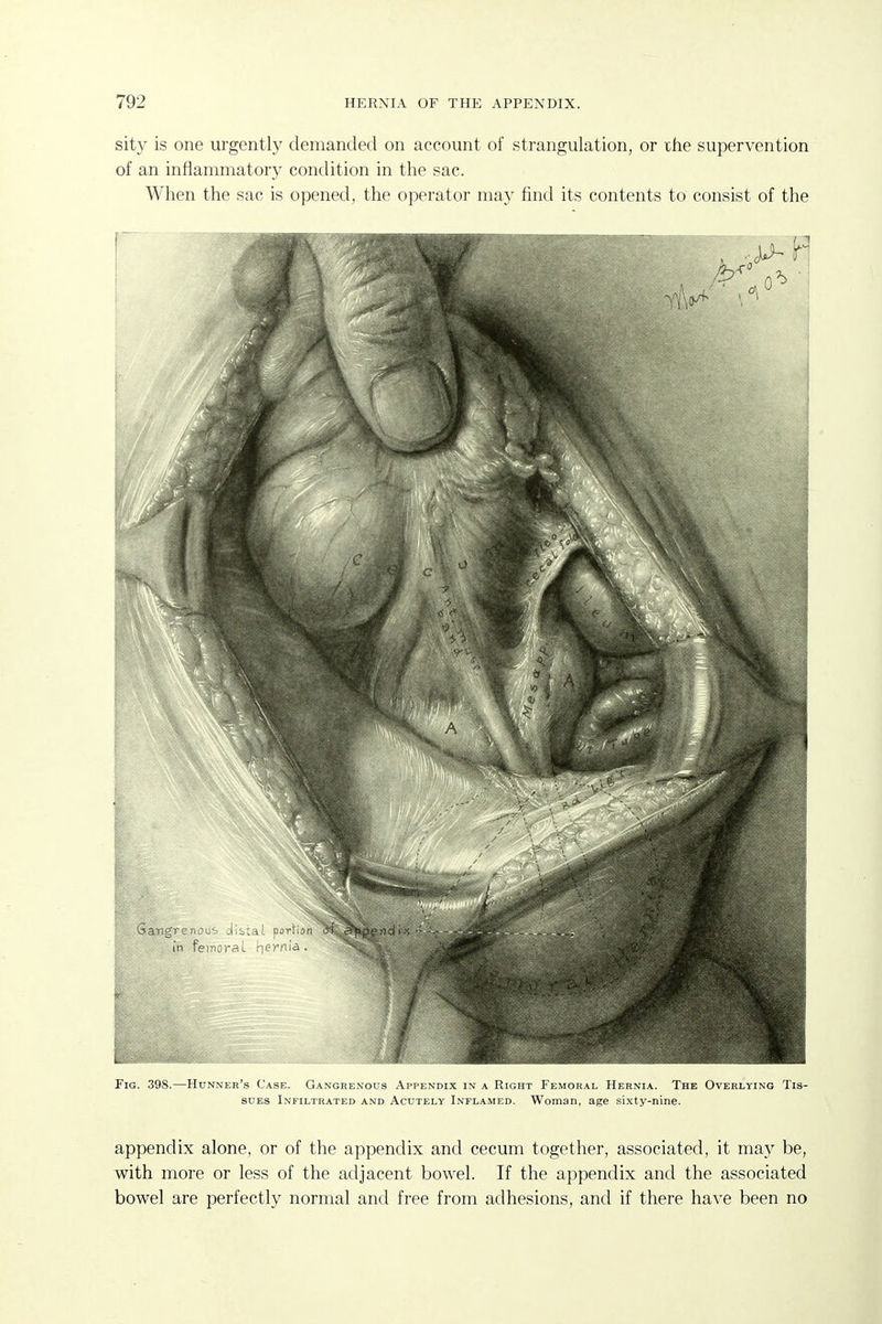 sity is one urgently demanded on account of strangulation, or the supervention of an inflammatory condition in the sac. When the sac is opened, the operator may find its contents to consist of the Fig. 398.—Hunner's Case. Gangrenous Appendix in a Right Femoral Hernia. The Overlying Tis- sues Infiltrated and Acutely Inflamed. Woman, age sixty-nine. appendix alone, or of the appendix and cecum together, associated, it may be, with more or less of the adjacent bowel. If the appendix and the associated bowel are perfectly normal and free from adhesions, and if there have been no