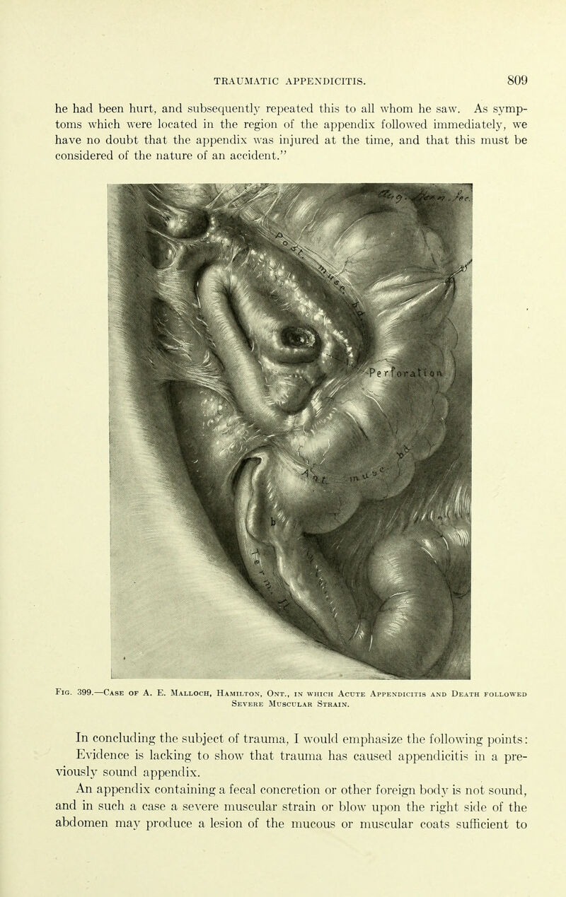 he had been hurt, and subsequently repeated this to all whom he saw. As symp- toms which were located in the region of the appendix followed immediately, we have no doubt that the appendix was injured at the time, and that this must be considered of the nature of an accident. Fig. 399.—Case of A. E. Malloch, Hamilton, Ont., in which Acute Appendicitis and Death followed Severe Muscular Strain. In concluding the subject of trauma, I would emphasize the following points: Evidence is lacking to show that trauma has caused appendicitis in a pre- Adously sound appendix. An appendix containing a fecal concretion or other foreign bodv is not sound, and in such a case a severe muscular strain or blow upon the right side of the abdomen may produce a lesion of the mucous or muscular coats sufficient to