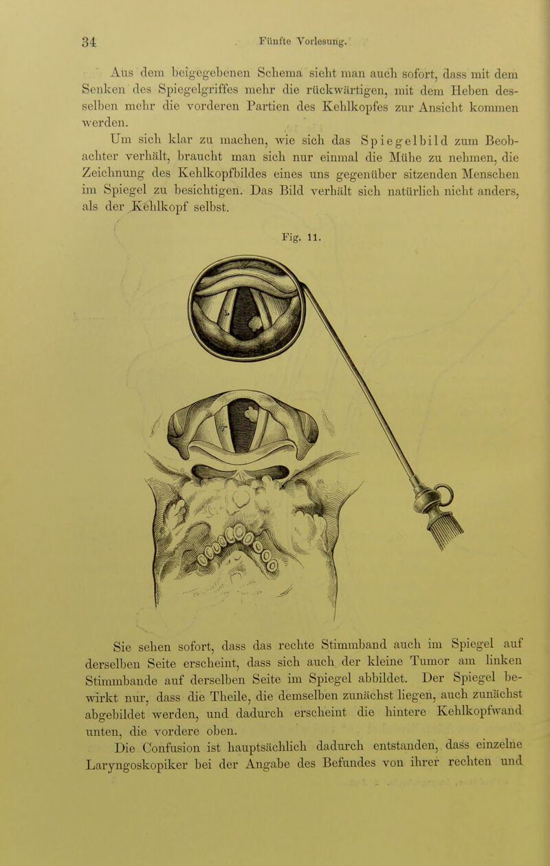 Aus dem beigegebenen Schema sieht mau auch sofort, dass mit dem Senken des Spiegelgriffes mehr die rückwärtigen, mit dem Heben des- selben mehr die vorderen Partien des Kehlkopfes zur Ansicht kommen werden. Um sich klar zu machen, wie sich das Spiegelbild zum Beob- achter verhält, braucht man sich nur einmal die Mühe zu nehmen, die Zeichnung des Kehlkopfbildes eines uns gegenüber sitzenden Menschen im Spiegel zu besichtigen. Das Bild verhält sich natürlich nicht anders, als der Kehlkopf selbst. Fig. 11. Sie sehen sofort, dass das rechte Stimmband auch im Spiegel auf derselben Seite erscheint, dass sich auch der kleine Tumor am linken Stimmbande auf derselben Seite im Spiegel abbildet. Der Spiegel be- wirkt nur, dass die Theile, die demselben zunächst liegen, auch zunächst abgebildet werden, und dadurch erscheint die hintere Kehlkopfwand unten, die vordere oben. Die Confusion ist hauptsächlich dadurch entstanden, dass einzelne Laryngoskopiker bei der Angabe des Befundes von ihrer rechten und