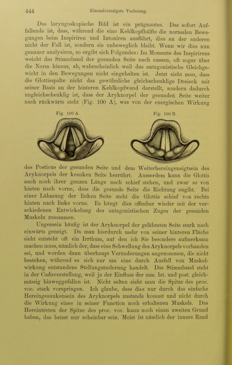 Das laryngoskopische Bild ist ein prägnantes. Das sofort Auf- fallende ist, dass, während die eine Kehlkopfhälfte die normalen Bewe- gungen beim Inspiriren und Intoniren ausführt, dies an der anderen nicht der Fall ist, sondern sie unbeweglich bleibt. Wenn wir dies nun genauer analysiren, so ergibt sich Folgendes: Im Momente des Inspirirens weicht das Stimmband der gesunden Seite nach aussen, oft sogar über die Norm hinaus, ab, wahrscheinlich weil das antagonistische Gleichge- wicht in den Bewegungen nicht eingehalten ist. Jetzt sieht man, dass die Glottisspalte nicht das gewöhnliche gleichschenklige Dreieck mit seiner Basis an der hinteren Kehlkopfwand darstellt, sondern dadurch ungleichschenklig ist, dass der Aryknorpel der gesunden Seite weiter nach rückwärts steht (Fig. 100 A), was von der energischen Wirkung Fig. 100 A. Fig. ioo B. des Posticus der gesunden Seite und dem Weiterhereingeneigtsein des Aryknorpels der kranken Seite herrührt. Ausserdem kann die Glottis auch noch ihrer ganzen Länge nach schief stehen, und zwar so von hinten nach vorne, dass die gesunde Seite die Richtung angibt. Bei einer Lähmung der linken Seite steht die Glottis schief von rechts hinten nach links vorne. Es hängt dies offenbar wieder mit der ver- schiedenen Entwicklung des antagonistischen Zuges der gesunden Muskeln zusammen. Ungemein häutig ist der Aryknorpel der gelähmten Seite stark nach einwärts geneigt. Da man hierdurch mehr von seiner hinteren Fläche sieht entsteht oft ein Irrthum, auf den ich Sie besonders aufmerksam machen muss, nämlich der, dass eine Schwellung des Aryknorpels vorhanden sei, und werden dann überhaupt Veränderungen angenommen, die nicht bestehen, während es sich nur um eine durch Ausfall von Muskel- Avirkung entstandene Stellungsänderung handelt. Das Stimmband steht in der Cadaverstellung, weil ja der Einfluss der mm. lat. und post. gleich- mässig hinweggefallen ist. Nicht selten sieht man die Spitze des proc. voc. stark vorspringen. Ich glaube, dass dies nur durch das einfache Hereingesunkensein des Aryknorpels zustande kommt und nicht durch die Wirkung eines in seiner Function noch erhaltenen Muskels. Das Hereintreten der Spitze des proc. voc. kann noch einen zweiten Grund haben, das heisst nur scheinbar sein. Meist ist nämlich der innere Rand