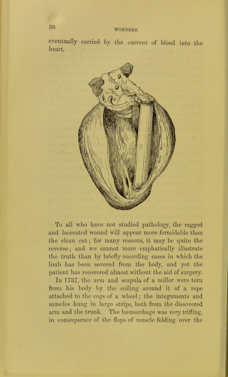 WONDERS. eventually carried by the current of blood into the heart. To all who have not studied pathology, the ragged and lacerated wound will appear more formidable than the clean cut; for many reasons, it may be quite the reverse; and we cannot more emphatically illustrate the truth than by briefly recording cases in which the limb has been severed from the body, and yet the patient has recovered almost without the aid of surgery. In 1737, the arm and scapula of a miller were torn from his body by the coiling around it of a rope attached to the cogs of a wheel; the integuments and muscles hung in large strips, both from the dissevered arm and the trunk. The haemorrhage was veiy trifling, in consequence of the flaps of muscle folding over the