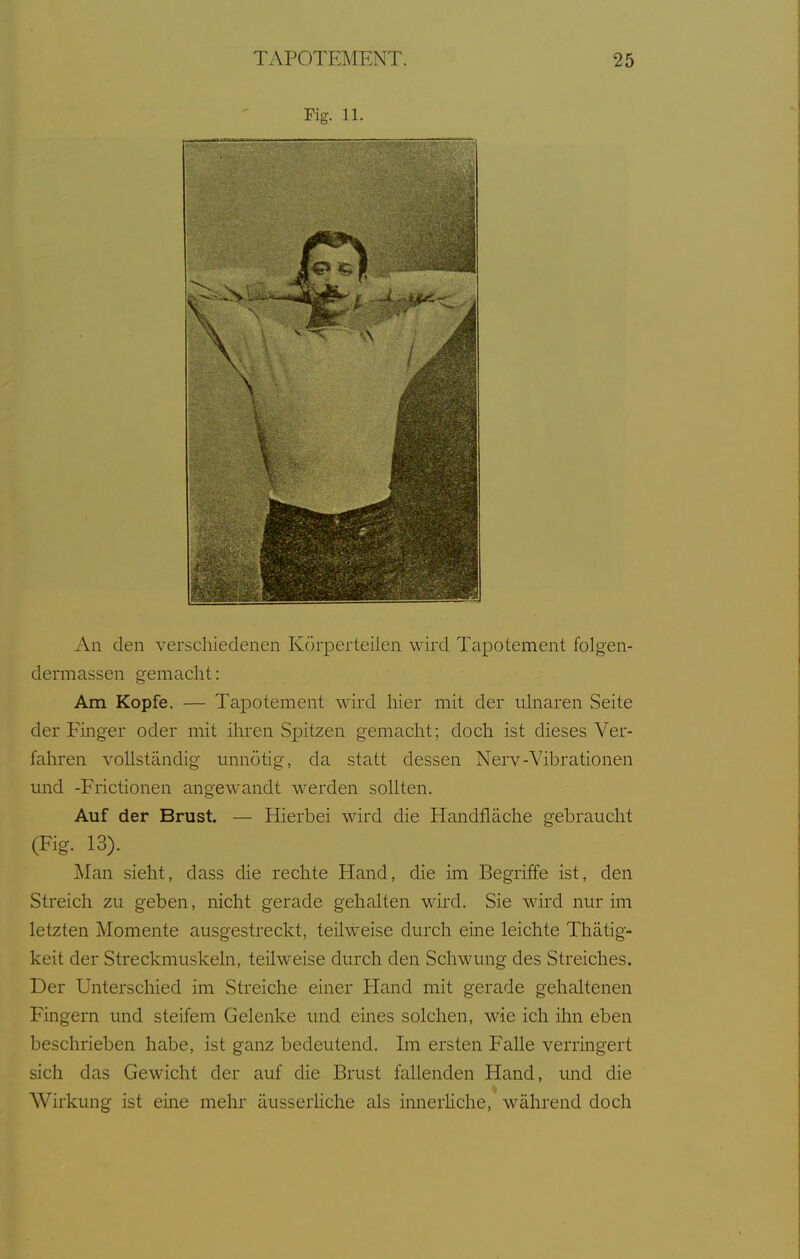 Fig. 11. An den verschiedenen Körperteilen wird Tapotement folgen- dermassen gemacht: Am Kopfe. — Tapotement wird hier mit der iihiaren Seite der Finger oder mit ihren Spitzen gemacht; doch ist dieses Ver- fahren vollständig unnötig, da statt dessen Nerv-Vibrationen mid -Frictionen angewandt werden sollten. Auf der Brust. — Hierbei wird die Handfläche gebraucht (Fig. 13). Man sieht, dass die rechte Hand, die im Begriffe ist, den Streich zu geben, nicht gerade gehalten wird. Sie wird nur im letzten Momente ausgestreckt, teilweise durch eine leichte Thätig- keit der Streckmuskeln, teilweise durch den Schwung des Streiches. Der Unterschied im Streiche einer Hand mit gerade gehaltenen Fingern und steifem Gelenke imd eines solchen, wie ich ihn eben beschrieben habe, ist ganz bedeutend. Im ersten FaUe verringert sich das Gewicht der auf die Brust fallenden Hand, imd die Wirkung ist eine mehr äusserüche als innerliche, während doch