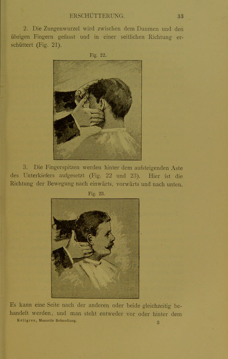 2. Die Zungenwurzel wird zwischen dem Daumen und den übrigen Fingern gefasst und in einer seitlichen Richtung er- schüttert (Fig. 21). Fig. 22. 3. Die Fingerspitzen werden hinter dem aufsteigenden Aste des Unterldefers aufgesetzt (Fig. 22 und 23). Hier ist die Richtung der Bewegung nach einwärts, vorwärts und nach unten. Fig. 23. Es kann eine Seite nach der anderen oder beide gleichzeitig be- handelt werden, und man steht entweder vor oder hinter dem Kellgrcn, Manuelle Behandlung. o