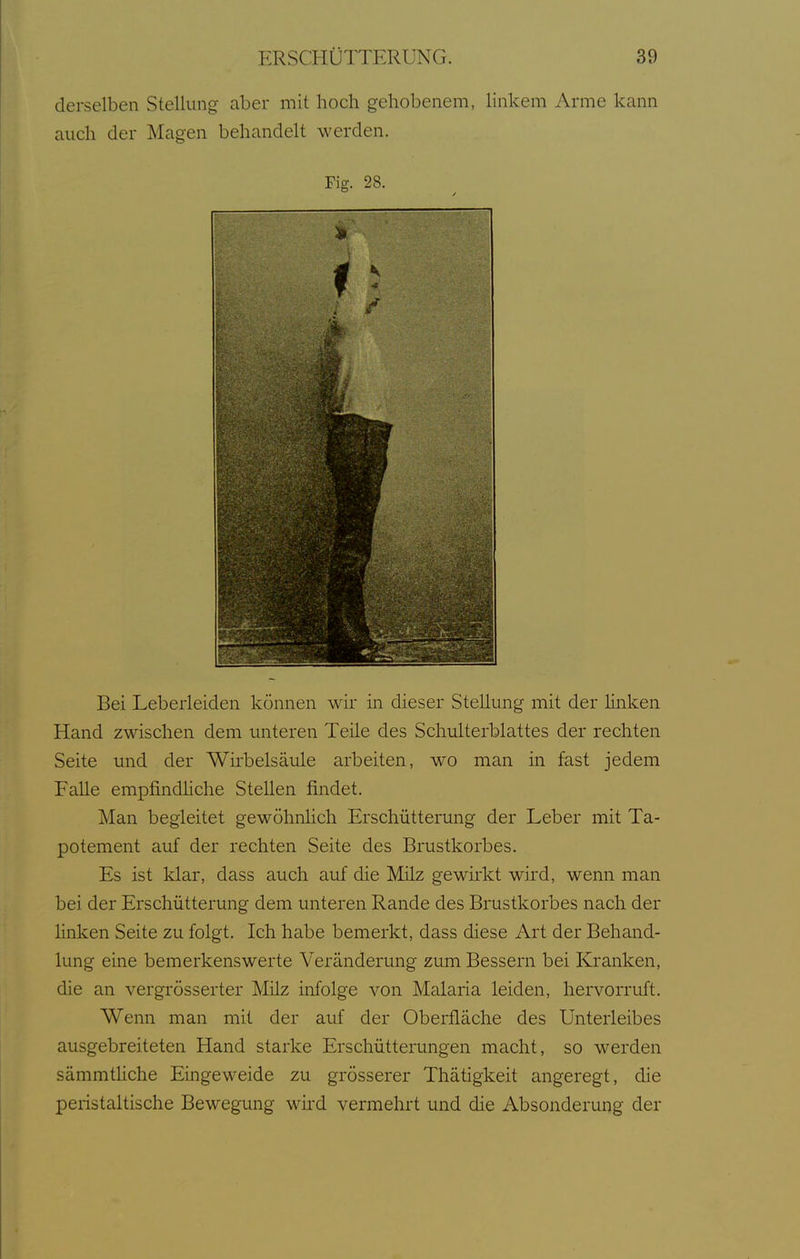derselben Stellung aber mit hoch gehobenem, linkem Arme kann auch der Magen behandelt werden. Fig. 28. Bei Leberleiden können wir in dieser Stellung mit der linken Hand zwischen dem unteren Teile des Schulterblattes der rechten Seite und der Wirbelsäule arbeiten, wo man in fast jedem Falle empfindhche Stellen findet. Man begleitet gewöhnHch Erschütterung der Leber mit Ta- potement auf der rechten Seite des Brustkorbes. Es ist klar, dass auch auf die Milz gewirkt wird, wenn man bei der Erschütterung dem unteren Rande des Brustkorbes nach der linken Seite zu folgt. Ich habe bemerkt, dass diese Art der Behand- lung eine bemerkenswerte Veränderung zum Bessern bei Kranken, die an vergrösserter Milz infolge von Malaria leiden, hervorruft. Wenn man mit der auf der Oberfläche des Unterleibes ausgebreiteten Hand starke Erschütterungen macht, so werden sämmtUche Eingeweide zu grösserer Thätigkeit angeregt, die peristaltische Bewegung wird vermehrt und die Absonderung der