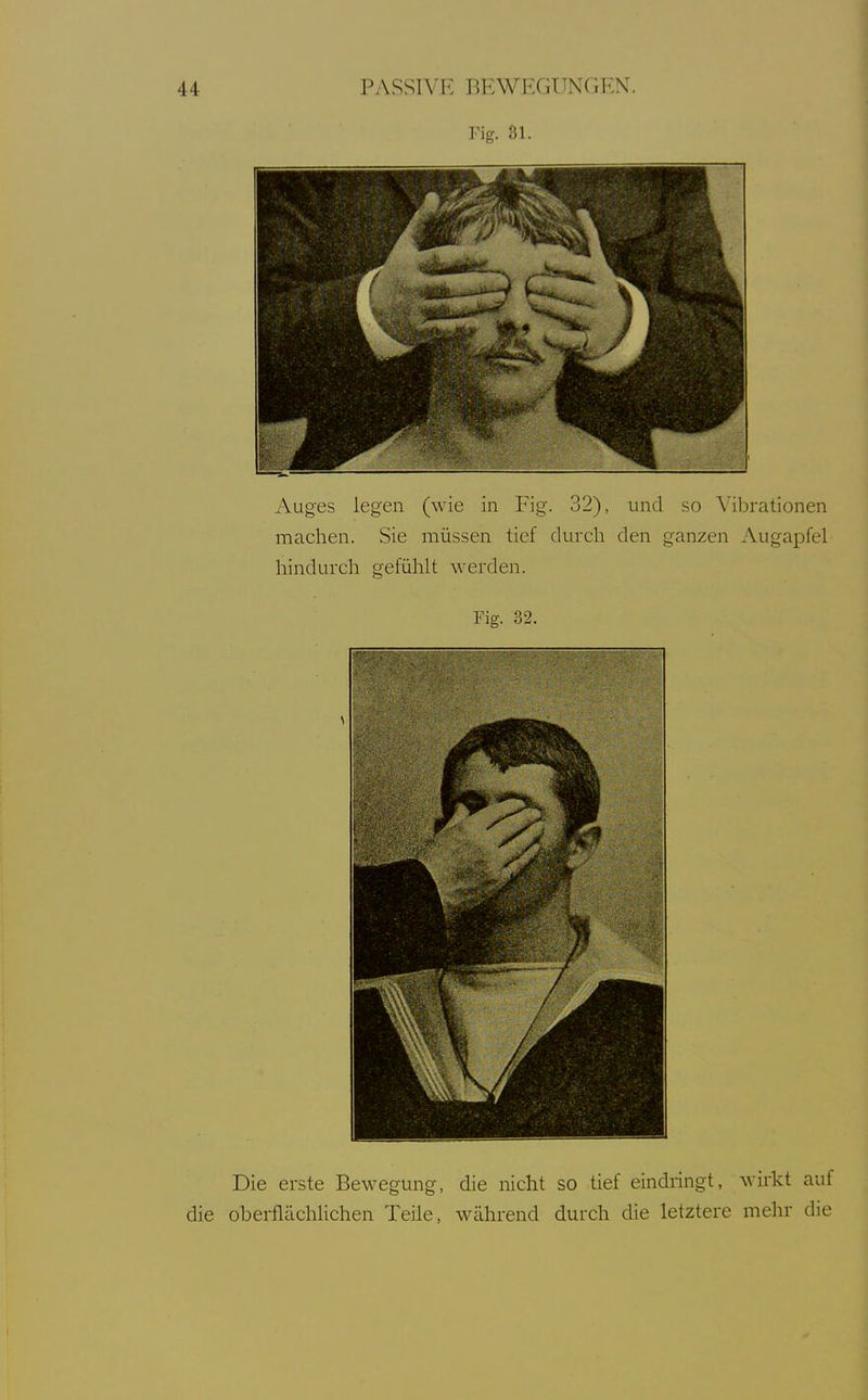 Fig. 31. Auges legen (wie in Fig. 32), und so \'ibrationen machen. Sie müssen tief durch den ganzen Augapfel hindurch gefühlt werden. Fig. 32. Die erste Bewegung, die nicht so tief eindringt, wirkt auf die oberflächlichen Teile, während durch die letztere mehr die