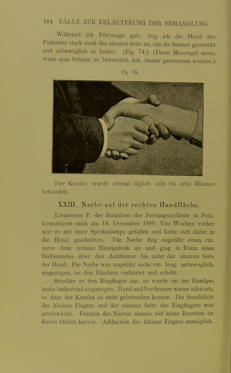 Während ich Pctrissage gab, bog ich die Hand des Patienten stark nach der ulnaren Seite zu, um die Sehnen gestreckt und unbeweghch zu halten. (Fig. 74.) (Diese Massregel muss, wenn man Sehnen zu behandeln hat, immer genommen werden.) Fig. 74. Der Kranke wurde einmal täglich acht bis zehn Minuten behandelt. XXin. Narbe auf der rechten Handfläche. Lieutenant P. des Bataillons der Festungsartillerie in Pola, konsultierte mich am 14. December 1888. Vier Wochen vorher war er mit einer Spirituslampe gefallen und hatte sich dabei in die Hand geschnitten. Die Narbe fing ungefähr einen cm. unter dem rechten Handgelenk an und ging in Form eines Halbmondes über den Antithenar bis nahe der ulnaren Seite der Hand. Die Narbe war ungefähr sechs cm. lang, unbeweghch, eingezogen, an den Rändern verhärtet und erhöht. Streckte er den Ringfinger aus, so wurde sie am Handge- lenke bedeutend eingezogen. Hand und Vorderarm waren schwach, so dass der Kranke sie nicht gebrauchen konnte. Die Sensibilität des kleinen Fingers und der ulnaren Seite des Ringfingers war geschwächt. Friction des Nervus ulnaris rief keine Reaction an diesen Stellen hervor. Adduction des kleinen Fingers unmöglich.