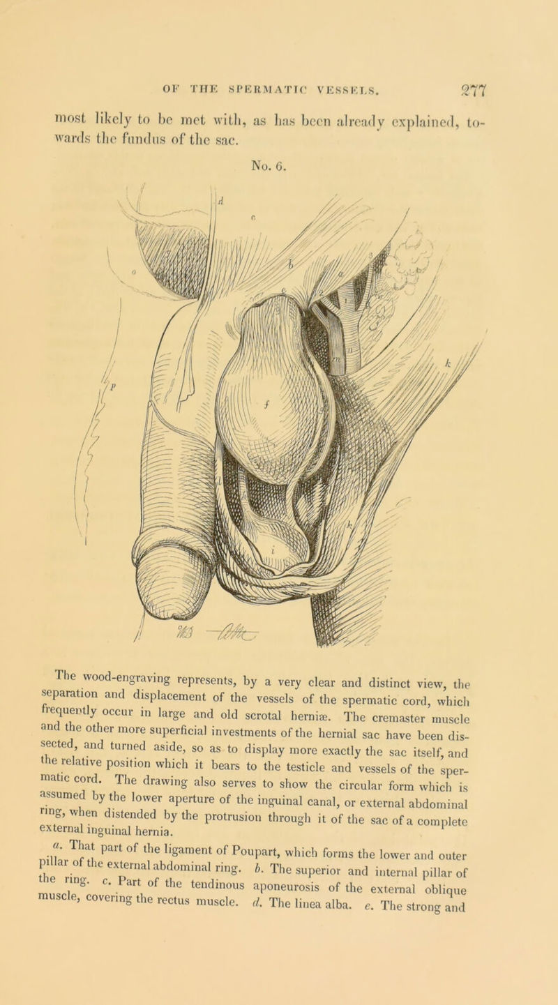OF THE Sf'FRMATir VFSSK1,S. m most likely to be met with, as 1ms been already explained, to- wards tlie fundus of the sac. No. G. The wood-engraving represents, by a very clear and distinct view, the separation and displacement of the vessels of the spermatic cord, which equei tly occui in large and old scrotal hernias. The cremaster muscle and the other more superficial investments of the hernial sac have been dis- sected and turned aside, so as to display more exactly the sac itself, and the relative position which it bears to the testicle and vessels of the sper- matic cord. The drawing also serves to show the circular form which is assumed by the lower aperture of the inguinal canal, or external abdominal nng,when distended by the protrusion through it of the sac of a complete external inguinal hernia. «. That part of the ligament of Poupart, which forms the lower and outer pi ar o t le external abdominal ring. h. The superior and internal pillar of ring. c. Part of the tendinous aponeurosis of the external oblique muscle, covering the rectus muscle, rf. The iinea alba. e. The strong and