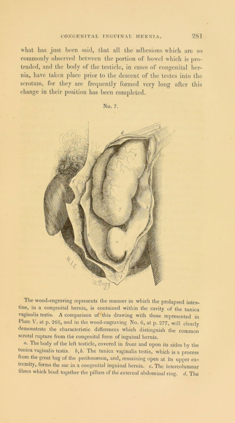 wliat lias just been said, that all the adlicsions which arc so commonly observed l)ctv;ccn the portion of bowel wliich is pro- truded, and tlic body of the testicle, in eases of congenital her- nia, have taken place prior to the descent of the testes into the scrotum, for they arc frcfjuently formed very long after this change in their position has been completed. No. 7. The wood-engraving represents the manner in which the prolapsed intes- tine, in a congenital hernia, is contained within the cavity of the tunica vaginalis testis. A comparison of'this drawing with those represented in Plate V. at p. 266, and in the wood-engraving No. 6, at p. 277, will clearly demonstrate the characteristic differences which distinguish the common scrotal rupture from the congenital form of inguinal hernia. a. The body of the left testicle, covered in front and upon its sides by the tunica vaginalis testis. b,b. The tunica vaginalis testis, which is a process from the great bag of the peritonteum, and, remaining open at its upper ex- tremity, forms the sac in a congenital inguinal hernia, c. The intercolumnar fibres which bind together the pillars of the external abdominal ring. d. The
