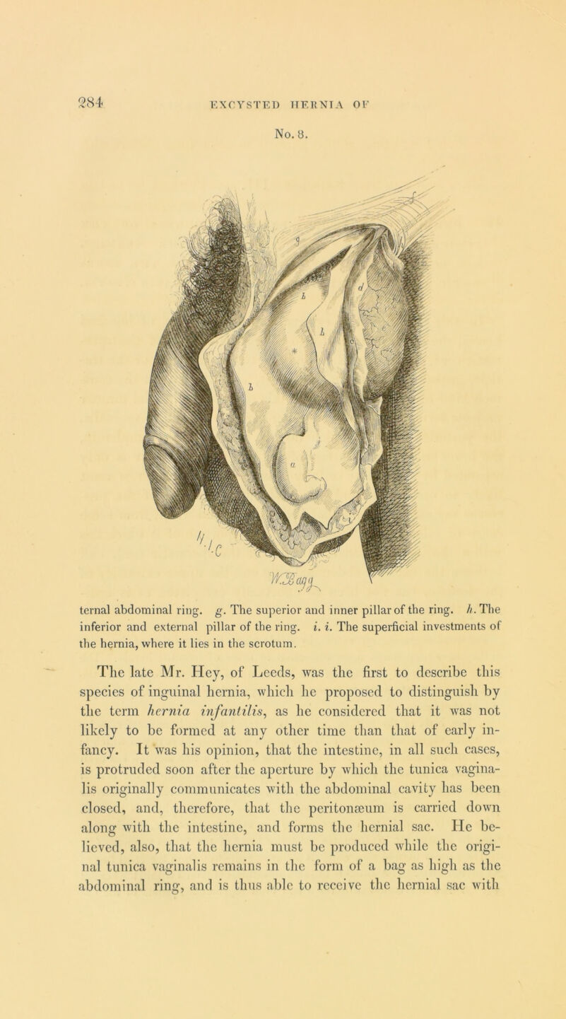 No. 8. ternal abdominal ring. g. The superior and inner pillar of the ring. h. The inferior and external pillar of the ring. i. i. The superficial investments of the hernia, where it lies in the scrotum. Tlie late Mr. Hey, of Leeds, was the first to describe tliis species of inguinal hernia, which he proposed to distinguish by the term hernia infantilis^ as he considered that it was not likely to be formed at any other time than that of early in- fancy. It was his opinion, that the intestine, in all such cases, is protruded soon after the aperture by which the tunica vagina- lis originally communicates with the abdominal cavity has been closed, and, therefore, that the peritonaeum is carried down along with the intestine, and forms the hernial sac. He be- lieved, also, that the hernia must be produced while the origi- nal tunica vaginalis remains in the form of a bag as high as the abdominal ring, and is thus able to receive the hernial sac with