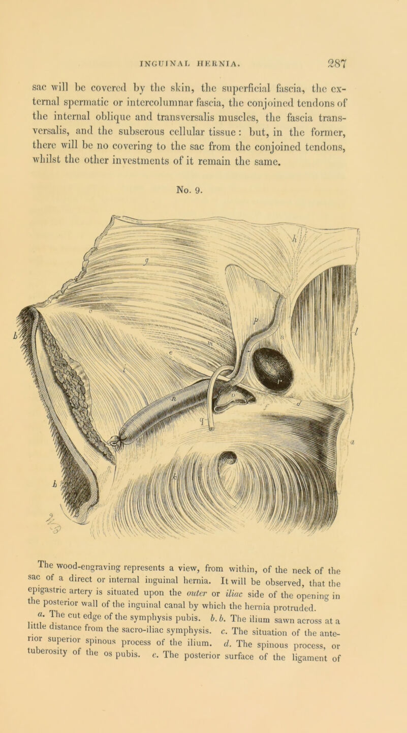 sac will be covered by the skin, tlic siijierfieial fascia, the ex- ternal spcrniatic or intcrcoliimnar fascia, the con joined tendons of the internal oblique and transversalis muscles, the fascia trans- vcrsalis, and the subserous cellular tissue: but, in the former, there will be no covering to the sac from the conjoined tendons, Avhilst the other investments of it remain the same. No. 9. The wood-engraving represents a view, from within, of the neck of the sac of a direct or internal inguinal hernia. It will be observed, that the epigastric artery is situated upon the outer or iliac side of the opening in tie posterior wall of the inguinal canal by which the hernia protruded. «. The cut edge of the symphysis pubis, b. b. The ilium sawn across at a 1 e distance from the sacro-iliac symphysis, c. The situation of the ante- perioi spinous process of the ilium, d. The spinous process, or tuberosity of the os pubis, c. The posterior surface of the ligament of