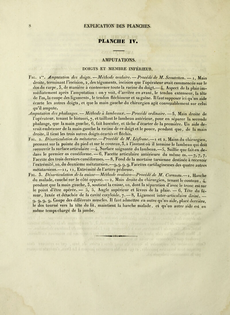 PLANCHE IV. AMPUTATIONS. DOIGTS ET MEMBRE INFÉRIEUR. Fig. i’c. Amputation des doigts.—Méthode ovalaire.—Procede de M. Scoutellen. — 1, Main droite, lerminant l’incision, 2, des téguments, incision que l’opéraleur avait commencée sur le dosdu carpe, 3, de manière à contourner toutela racine da doig't.— 4> Aspect de la plaieim- médiatement après l’amputation : on y voit, d’arrière en avant, le tendon extenseur, la tète de l’ostia coupé des ligaments, le tendon fléchisseur et sagaine. Il fautsupposer ici qu’un aide écarte les autres doigts, et que la main gauche du chirurgien agit conveDablemenl sur celui qu’il ampule. Amputation des phalanges. •—• Méthode a lambeaux.—Procede ordinarne.—5, Main droite de l’opérateur, tenant le bistouri, 7, et taillanl le lambeau antérieur, pour en séparer la seconde phalange, que la main gauche, 6, fait basculer, et tàche d’écarter de la première. Un aide de- vrait embrasser de la main gauche la racine de ce doigt et le pouce, pendant que, de la main droite, il tient les trois autres doigts écartés et fìéchis. Fig. 2. Dèsarticulation du métalarse.—Procede de M. Lisfranc.—1 et 2,Mainsdu chirurgien, pressaut sur la pointe du pied et sur le couteau, 3, à l’instant où il termine le lambeau qui doit recouvrir la surface articulaire —4? Surface saignante du lambeau.—5, Saillie que fait en de- dans le premier os cuneiforme. — 6, Facette articulaire anlérieure du mèrae os. 7, 7, 7, Facelte des trois derniers cunéiformes. — 8, Fond de la mortaise larsienne destinée à recevoir l’extrémilé, 10, du deuxième métatarsien.—9,9,9,9, Faceltes cartilagineuses des quatre autres métatarsiens.—11, 11, Extrémité de l’artère pédieuse. Fig. 3. Dèsarticulation de la cuisse—Méthode ovalaire—Procede de M. Cornuau.—1, Manche du malade, couché sur le coté oppose. — 2, Main droite du chirurgien, tenant le couteau , 4, pendant que la main gauche, 3, soutient la cuisse, 10, dont la séparalion d’avec le tronc est sur le point a’èlre opérée. — 5, 5, Angle supérieur et lèvres de la plaie. — 6, Tète du fé- mur, luxée et détachée de la cavile cotyloide, 7. — 8, Ligament iuter-articulaire divise. 9, 9, 9, 9, Coupé des différents muscles. Il faut admettre en outre qu’un aide, place derrière, le dos tourné vers la tète du lit, maintient la banche malade, et qu’un antro aide est en méme tempschargé de la jambe. Q-Q<r