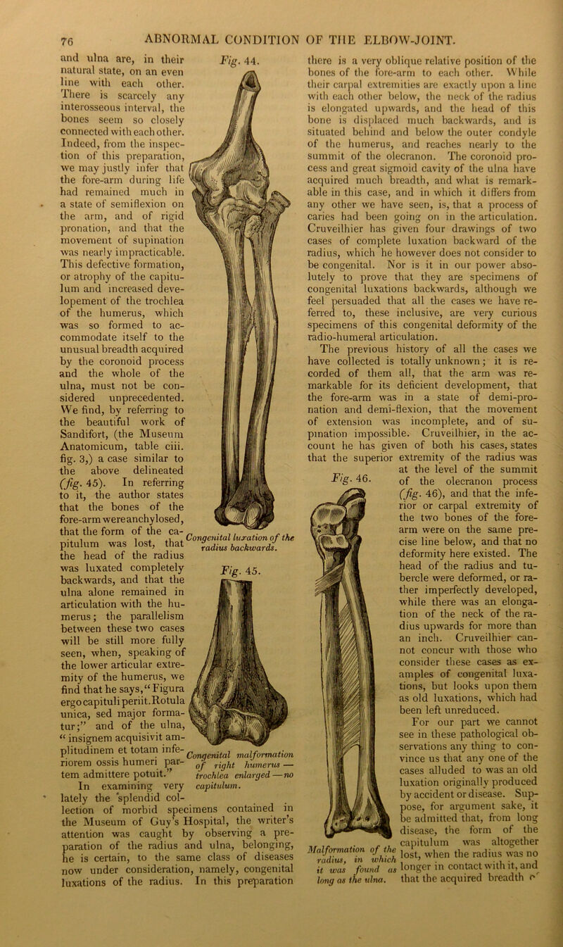 Fig. 44. and ulna are, in their natural state, on an even line with each other. There is scarcely any interosseous interval, the bones seem so closely connected with each other. Indeed, from the inspec- tion of this preparation, we may justly infer that the fore-arm during life had remained much in a state of semiflexion on the arm, and of rigid pronation, and that the movement of supination was nearly impracticable. This defective formation, or atrophy of the capitu- lum and increased deve- lopement of the trochlea of the humerus, which was so formed to ac- commodate itself to the unusual breadth acquired by the coronoid process and the whole of the ulna, must not be con- sidered unprecedented. We find, by referring to the beautiful work of Sandifort, (the Museum Anatomicum, table ciii. fig. 3,) a case similar to the above delineated (fig. 45). In referring to it, the author states that the bones of the fore-arm were anchylosed, that the form of the ca- _ ... . ... pitulum was lost, hat f(liUS backward( the head of the radius was luxated completely backwards, and that the ulna alone remained in articulation with the hu- merus ; the parallelism between these two cases will be still more fully seen, when, speaking of the lower articular extre- mity of the humerus, we find that he says,“Figura ergocapituliperiit.Rotula unica, sed major forma- tur;” and of the ulna, “ insignem acquisivit am- ^ plitudinem et totam infe Qom.ennai malformation norem ossis humeri par- 0j right humerus — tem admittere potuit.” trochlea enlarged—no In examining very capitulum. lately the splendid col- lection of morbid specimens contained in the Museum of Guy’s Hospital, the writer’s attention was caught by observing a pre- paration of the radius and ulna, belonging, he is certain, to the same class of diseases now under consideration, namely, congenital luxations of the radius. In this preparation Fig. 45. there is a very oblique relative position of the bones of the fore-arm to each other. While their carpal extremities are exactly upon a line with each other below, the neck of the radius is elongated upwards, and the head of this bone is displaced much backwards, and is situated behind and below the outer condyle of the humerus, and reaches nearly to the summit of the olecranon. The coronoid pro- cess and great sigmoid cavity of the ulna have acquired much breadth, and what is remark- able in this case, and in which it differs from any other we have seen, is, that a process of caries had been going on in the articulation. Cruveilhier has given four drawings of two cases of complete luxation backward of the radius, which he however does not consider to be congenital. Nor is it in our power abso- lutely to prove that they are specimens of congenital luxations backwards, although we feel persuaded that all the cases we have re- ferred to, these inclusive, are very curious specimens of this congenital deformity of the radio-humeral articulation. The previous history of all the cases we have collected is totally unknown; it is re- corded of them all, that the arm was re- markable for its deficient development, that the fore-arm was in a state of demi-pro- nation and demi-flexion, that the movement of extension was incomplete, and of su- pination impossible. Cruveilhier, in the ac- count he has given of both his cases, states that the superior extremity of the radius was at the level of the summit F/g. 46. 0f tpe olecranon process (fig. 46), and that the infe- rior or carpal extremity of the two bones of the fore- KMT Up arm were on the same pre- cise line below, and that no deformity here existed. The head of the radius and tu- bercle were deformed, or ra- ther imperfectly developed, while there was an elonga- tion of the neck of the ra- dius upwards for more than an inch. Cruveilhier can- not concur with those who consider these cases as ex- amples of congenital luxa- tions, but looks upon them as old luxations, which had been left unreduced. For our part we cannot see in these pathological ob- servations any thing to con- vince us that any one of the cases alluded to was an old luxation originally produced by accident or disease. Sup- pose, for argument sake, it Ml!® be admitted that, from long disease, the form of the . . , capitulum was altogether Malformation of the j * w, the radius was no it was found longer in contact with it, and long as the ulna, that the acquired breadth c