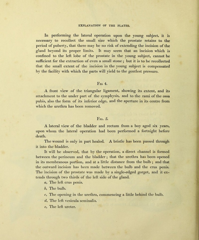 In performing the lateral operation upon the young subject, it is necessary to recollect the small size which the prostate retains to the period of puberty, that there may be no risk of extending the incision of the gland beyond its proper limits. It may seem that an incision which is confined to the left lobe of the prostate in the young subject, cannot be sufficient for the extraction of even a small stone ; but it is to be recollected that the small extent of the incision in the young subject is compensated by the facility with which the parts will yield to the gentlest pressure. Fig 4. A front view of the triangular ligament, showing its extent, and its attachment to the under part of the symphysis, and to the rami of the ossa pubis, also the form of its inferior edge, and the aperture in its centre from which the urethra has been removed. Fig. 5. A lateral view of the bladder and rectum from a boy aged six years, upon whom the lateral operation had been performed a fortnight before death. The wound is only in part healed. A bristle has been passed through it into the bladder. It will be observed, that by the operation, a direct channel is formed between the perineum and the bladder ; that the urethra has been opened in its membranous portion, and at a little distance from the bulb ; and that the outward incision has been made between the bulb and the crus penis. The incision of the prostate was made by a single-edged gorget, and it ex- tends through two thirds of the left side of the gland. a, The left crus penis. b, The bulb. c, The opening in the urethra, commencing a little behind the bulb. d, The left vesicula seminalis. e, The left ureter.