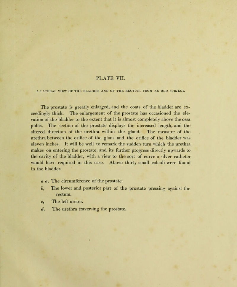 PLATE VII. A LATERAL VIEW OF THE BLADDER AND OF THE RECTUM, FROM AN OLD SUBJECT. The prostate is greatly enlarged, and the coats of the bladder are ex- ceedingly thick. The enlargement of the prostate has occasioned the ele- vation of the bladder to the extent that it is almost completely above the ossa pubis. The section of the prostate displays the increased length, and the altered direction of the urethra within the gland. The measure of the urethra between the orifice of the glans and the orifice of the bladder was eleven inches. It will be well to remark the sudden turn which the urethra makes on entering the prostate, and its further progress directly upwards to the cavity of the bladder, with a view to the sort of curve a silver catheter would have required in this case. Above thirty small calculi were found in the bladder. a a, The circumference of the prostate. b, The lower and posterior part of the prostate pressing against the rectum. c, The left ureter. d, The urethra traversing the prostate.