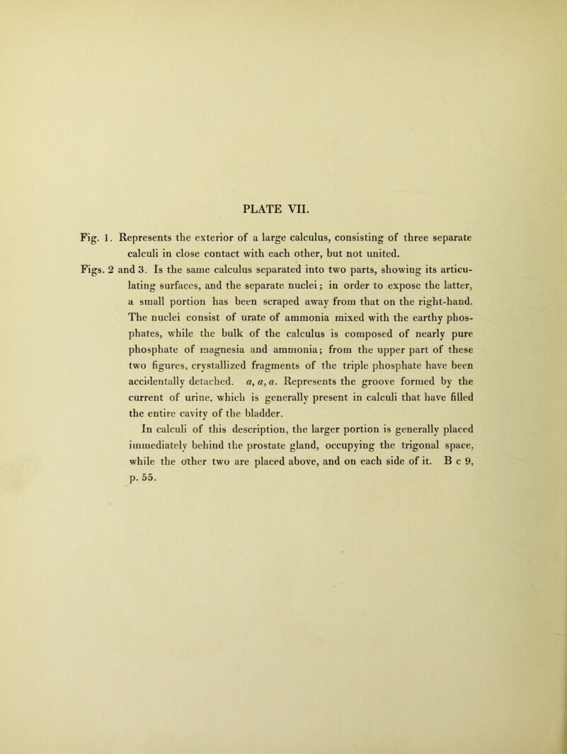Fig. 1. Represents the exterior of a large calculus, consisting of three separate calculi in close contact with each other, but not united. Figs. 2 and 3. Is the same calculus separated into two parts, showing its articu- lating surfaces, and the separate nuclei; in order to expose the latter, a small portion has been scraped away from that on the right-hand. The nuclei consist of urate of ammonia mixed with the earthy phos- phates, while the bulk of the calculus is composed of nearly pure phosphate of magnesia and ammonia; from the upper part of these two figures, crystallized fragments of the triple phosphate have been accidentally detached. «, a, a. Represents the groove formed by the current of urine, which is generally present in calculi that have filled the entire cavity of the bladder. In calculi of this description, the larger portion is generally placed immediately behind the prostate gland, occupying the trigonal space, while the other two are placed above, and on each side of it. B c 9, p. 55.