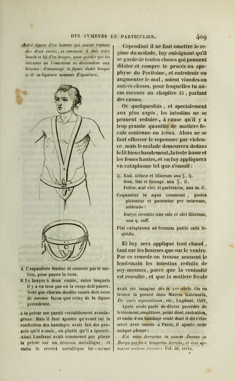 Autre figure d'rn homme qui auroit rupture des deux costés, et comment il doit cslre bandé et lté d’vn brayer, pour garder que les intestins ou l omentum ne descendent aux bourses : d’auantuge la figure dudit brayer et de sa ligature nommée Espauliere. A I.’espauliere fendue et ouuerfe parle mi- lieu, pour passer la leste. B I.c brayer à deux costés, entre lesquels il y a vn trou par où la verge doit passer. .Vote que chacun desdits costés doit estre de mesme façon que celuy de la figure precedente. à la pelote me parait véritablement avanta- geuse. Mais il faut ajouter qu’avant lui la confection des bandages avait fait des pro- grès qu’il a omis , ou plutôt qu’il a ignorés. Ainsi I.anfranc avait commencé par placer la pelote sur un écusson métallique, et enfiu le ressort métallique lui-même Cependant il ne faut omettre le ré- gime du malade, luy enioignant qu'il se garde de toutes choses qui peuuent dilater et rompre le procès ou apo- physe du Péritoine, et entretenir ou augmenter le mal, soient viandes ou autres choses, pour lesquelles tu au- ras recours au chapitre 15 , parlant des causes. Or quelquesfois , et spécialement aux pîus aagés , les intestins ne se peuuent réduire, à cause qu'il y a trop grande quantité de matière fe- cale contenue en iceux. Alors ne se faut efforcer le repousser par violen- ce. mais le malade demeurera dedans le lit bien chaudement,la teste basse et les fesses hautes, et on luy appliquera vn cataplasme tel que s’ensuit : %. Rad. altheæ et liliorum ana 5 . ij. Sem. lini et fœnugr. ana 5 . G. Folior. mal viol, et parietariæ, ana m. G. Coquantur in aqua communi , postea pistentur et passentur per setaceum, addendo: Butyri recentis sine sale et olei liliorum, ana q. sufl’. Fiat cataplasma ad formam pultis satis li- quida;. Et luy sera appliqué tout chaud , tant sur les bourses que sur le ventre. Par ce remede on trouue souuent le lendemain les intestins réduits de soy-mesmes, parce que la ventosité est resoulte, et que la matière fecale avait été imaginé dès le xv» siècle. On en trouve la preuve dans Marcus Gatenaria, De curis æjrilndinum , etc., Lugduni, 1532. Après avoir parlé de divers procédés de traitement,emplâtres, point doré,castration, et enfin d'un bandage roulé dont il dits’ètre servi avec succès à Pavic, il ajoute cette unique phrase : Est unus ferrarius in sancto Joanne in Burgo qui facit bragerios ferreos, et sunt op- limi et mnlium jurantes. Fol. Sfi, recto.