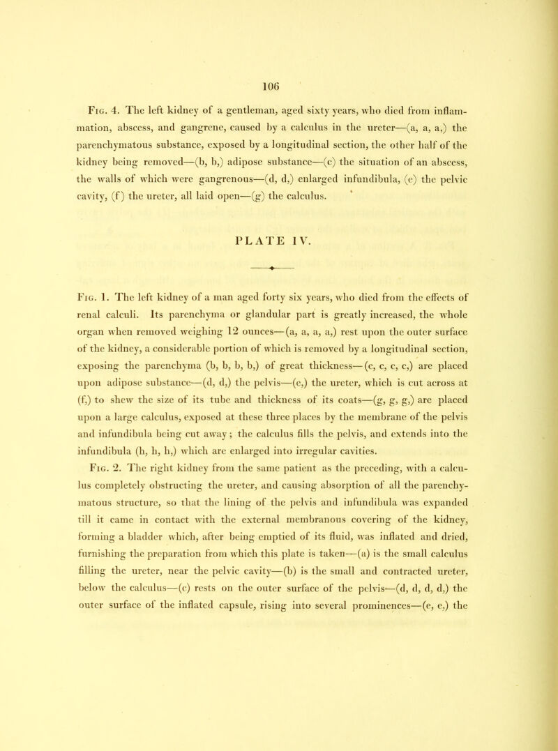 Fig. 4. The left kidney of a gentleman, aged sixty years, who died from inflam- mation, abscess, and gangrene, caused by a calculus in the ureter—(a, a, a,) the parenchymatous substance, exposed by a longitudinal section, the other half of the kidney being removed—(b, b,) adipose substance—(c) the situation of an abscess, the walls of which were gangrenous—(d, d,) enlarged infundibula, (e) the pelvic cavity, (f) the ureter, all laid open—(g) the calculus. PLATE IV. Fig. 1. The left kidney of a man aged forty six years, who died from the effects of renal calculi. Its parenchyma or glandular part is greatly increased, the whole organ when removed weighing 12 ounces—(a, a, a, a,) rest upon the outer surface of the kidney, a considerable portion of which is removed by a longitudinal section, exposing the parenchyma (b, b, b, b,) of great thickness—(c, c, c, c,) are placed upon adipose substance—(d, d,) the pelvis—(e,) the ureter, which is cut across at (f,) to shew the size of its tube and thickness of its coats—(g, g, g,) are placed upon a large calculus, exposed at these three places by the membrane of the pelvis and infundibula being cut away; the calculus fills the pelvis, and extends into the infundibula (h, h, h,) which are enlarged into irregular cavities. Fig. 2. The right kidney from the same patient as the preceding, with a calcu- lus completely obstructing the ureter, and causing absorption of all the parenchy- matous structure, so that the lining of the pelvis and infundibula was expanded till it came in contact with the external membranous covering of the kidney, forming a bladder which, after being emptied of its fluid, was inflated and dried, furnishing the preparation from which this plate is taken—(a) is the small calculus filling the ureter, near the pelvic cavity—(b) is the small and contracted ureter, below the calculus—(c) rests on the outer surface of the pelvis—(d, d, d, d,) the outer surface of the inflated capsule, rising into several prominences—(e, e,) the