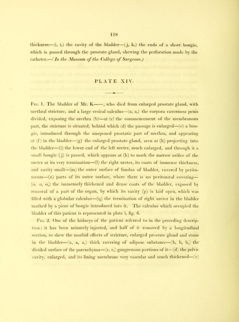 thickness—(i, i,) the cavity of the bladder—(j, k,) the ends of a short bougie, which is passed through the prostate gland, shewing the perforation made by the catheter.—(In the Museum of the College of Surgeons.) PLATE XIV. Fig. 1. The bladder of Mr. K , who died from enlarged prostate gland, with urethral stricture, and a large vesical calculus—(a, a,) the corpora cavernosa penis divided, exposing the urethra (b)—at (c) the commencement of the membranous part, the stricture is situated, behind which (d) the passage is enlarged—(e) a bou- gie, introduced through the unopened prostatic part of urethra, and appearing at (f) in the bladder—(g) the enlarged prostate gland, seen at (h) projecting into the bladder—(i) the lower end of the left ureter, much enlarged, and through it a small bougie ( j) is passed, which appears at (k) to mark the narrow orifice of the ureter at its very termination—(1) the right ureter, its coats of immense thickness, and cavity small—(m) the outer surface of fundus of bladder, covered by perito- naeum—(n) parts of its outer surface, where there is no peritonaeal covering— (o, o, o,) the immensely thickened and dense coats of the bladder, exposed by removal of a part of the organ, by which its cavity (p) is laid open, which was filled with a globular calculus—(q) the termination of right ureter in the bladder marked by a piece of bougie introduced into it. The calculus which occupied the bladder of this patient is represented in plate i, fig. G. Fig. 2. One of the kidneys of the patient referred to in the preceding descrip- tion; it has been minutely injected, and half of it removed by a longitudinal section, to shew the morbid effects of stricture, enlarged prostate gland and stone in the bladder—(a, a, a,) thick covering of adipose substance—(b, b, b,) the divided surface of the parenchyma—(c, c,) gangrenous portions of it—(d) the pelvic cavity, enlarged, and its lining membrane very vascular and much thickened—(e)