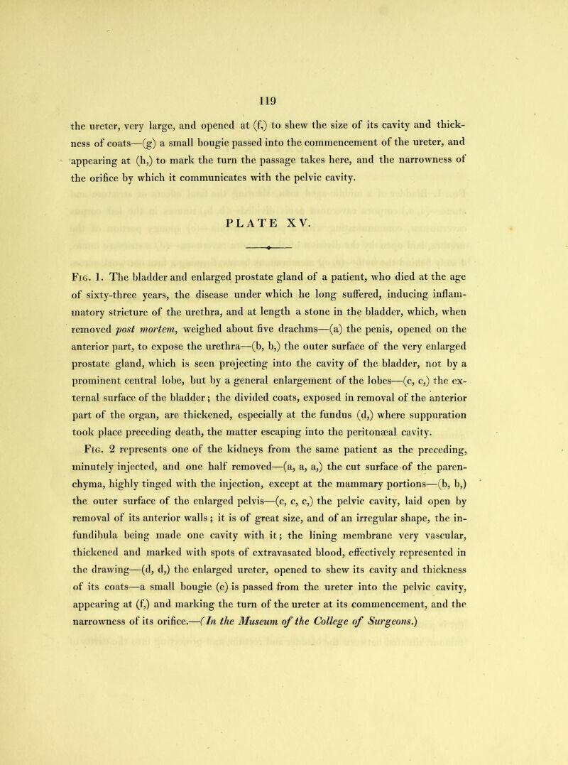 the ureter, very large, and opened at (f,) to shew the size of its cavity and thick- ness of coats—(g) a small bougie passed into the commencement of the ureter, and appearing at (h,) to mark the turn the passage takes here, and the narrowness of the orifice by which it communicates with the pelvic cavity. PLATE XV. Fig. 1. The bladder and enlarged prostate gland of a patient, who died at the age of sixty-three years, the disease under which he long suffered, inducing inflam- matory stricture of the urethra, and at length a stone in the bladder, which, when removed post mortem, weighed about five drachms—(a) the penis, opened on the anterior part, to expose the urethra—(b, b,) the outer surface of the very enlarged prostate gland, which is seen projecting into the cavity of the bladder, not by a prominent central lobe, but by a general enlargement of the lobes—(c, c,) the ex- ternal surface of the bladder; the divided coats, exposed in removal of the anterior part of the organ, are thickened, especially at the fundus (d,) where suppuration took place preceding death, the matter escaping into the peritonseal cavity. Fig. 2 represents one of the kidneys from the same patient as the preceding, minutely injected, and one half removed—(a, a, a,) the cut surface of the paren- chyma, highly tinged with the injection, except at the mammary portions—(b, b,) the outer surface of the enlarged pelvis—(c, c, c,) the pelvic cavity, laid open by removal of its anterior walls ; it is of great size, and of an irregular shape, the in- fundibula being made one cavity with it; the lining membrane very vascular, thickened and marked with spots of extravasated blood, effectively represented in the drawing—(d, d,) the enlarged ureter, opened to shew its cavity and thickness of its coats—a small bougie (e) is passed from the ureter into the pelvic cavity, appearing at (f,) and marking the turn of the ureter at its commencement, and the narrowness of its orifice.—(In the Museum of the College of Surgeons.)