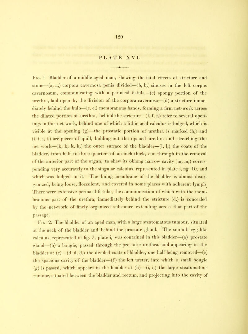 PLATE XVI. Fig. 1. Bladder of a middle-aged man, shewing the fatal effects of stricture and stone—(a, a,) corpora cavernosa penis divided—(b, b,) sinuses in the left corpus cavernosum, communicating with a perinaeal fistula—(c) spongy portion of the urethra, laid open by the division of the corpora cavernosa—(d) a stricture imme. diately behind the bulb—(e, e,) membranous bands, forming a firm net-work across the dilated portion of urethra, behind the stricture—(f, f, f,) refer to several open- ings in this net-wrork, behind one of which a lithic-acid calculus is lodged, w'hicli is visible at the opening (g)—the prostatic portion of urethra is marked (h,) and (i, i, i, i,) are pieces of quill, holding out the opened urethra and stretching the net work—(k, k, k, k,) the outer surface of the bladder—(1, 1,) the coats of the bladder, from half to three quarters of an inch thick, cut through in the removal of the anterior part of the organ, to shew its oblong narrow cavity (m, m,) corres- ponding very accurately to the singular calculus, represented in plate i, fig. 10, and which wras lodged in it. The lining membrane of the bladder is almost disor- ganized, being loose, flocculent, and covered in some places with adherent lymph There were extensive perinaeal fistulas, the communication of which wdth the mem- branous part of the urethra, immediately behind the stricture (d,) is concealed by the net-wrork of finely organized substance extending across that part of the passage. Fig. 2. The bladder of an aged man, w'ith a large steatomatous tumour, situated at the neck of the bladder and behind the prostate gland. The smooth egg-like calculus, represented in fig. 7, plate i, was contained in this bladder—(a) prostate gland—(b) a bougie, passed through the prostatic urethra, and appearing in the bladder at (c)—(d, d, d,) the divided coats of bladder, one half being removed—(e) the spacious cavity of the bladder—(f) the left ureter, into which a small bougie (g) is passed, which appears in the bladder at (h)—(i, i,) the large steatomatous tumour, situated between the bladder and rectum, and projecting into the cavity of