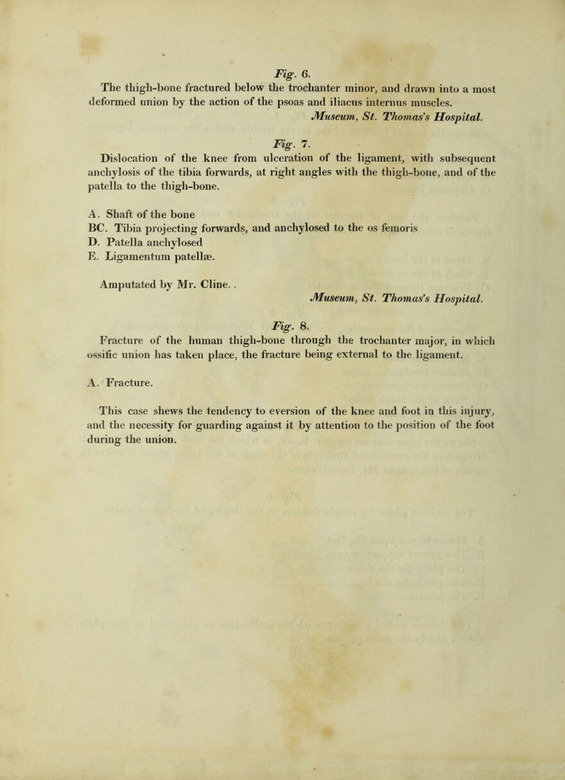 Fig. 6. The thigh-bone fractured below the trochanter minor, and drawn into a most deformed union by the action of the psoas and iliacus internus muscles. JMuseum, St. Thomas's Hospital. Fig. 7. Dislocation of the knee from ulceration of the ligament, with subsequent anchylosis of the tibia forwards, at right angles with the thigh-bone, and of the patella to the thigh-bone. A. Shaft of the bone BC. Tibia projecting forwards, and anchylosed to the os femoris D. Patella anchylosed E. Ligamentum patellae. Amputated by Mr. Cline., jyiuseum, St. Thomas's Hospital. Fig. 8. Fracture of the human thigh-bone through the trochanter major, in wliich ossific union has taken place, the fracture being external to the ligament. A, Fracture. This case shews the tendency to eversion of the knee and foot in this injury, and the necessity for guarding against it by attention to the position of the foot during the union.