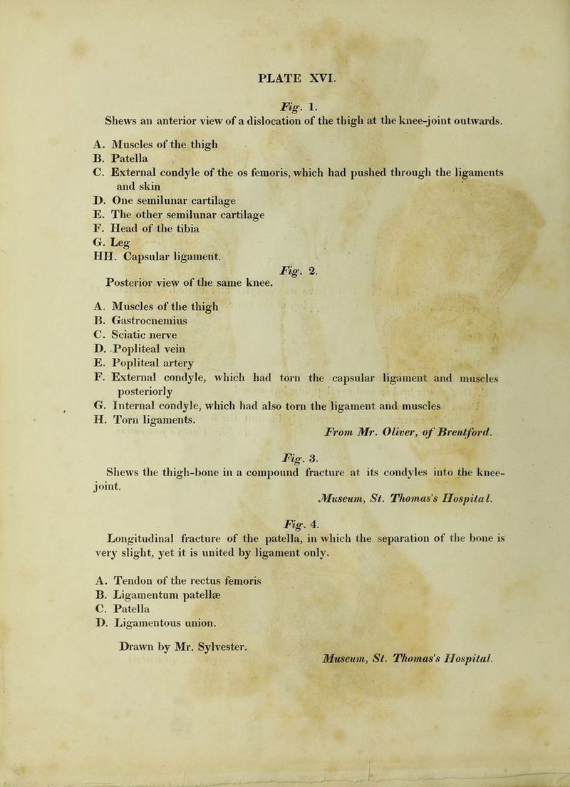 Fig. 1. Shews an anterior view of a dislocation of the thigh at the knee-joint outwards. A. Muscles of the thigh B. Patella C. External condyle of the os femoris, which had pushed through the ligaments and skin D. One semilunar cartilage E. The other semilunar cartilage F. Head of the tibia G. Leg HH. Capsular ligament. Fig, 2. Posterior view of the same knee. A. Muscles of the thigh B. Gastrocnemius C. Sciatic nerve D. ^Popliteal vein E. Popliteal artery F. External condyle, which had torn the capsular ligament and muscles posteriorly G. Internal condyle, which had also torn the ligament and muscles H. Torn ligaments. From Mr. Oliver, of Brentford. Fig. 3. Shews the thigh-bone in a compound fracture at its condyles into the knee- joint. Museum, St. Thomas’s Hospital. Fig. 4. Longitudinal fracture of the patella, in which the separation of the bone is very slight, yet it is united by ligament only. A. Tendon of the rectus femoris B. Ligamentum patellae C. Patella D. Ligamentous union. Drawn by Mr. Sylvester. Museum, St. Thomas’s Hospital.