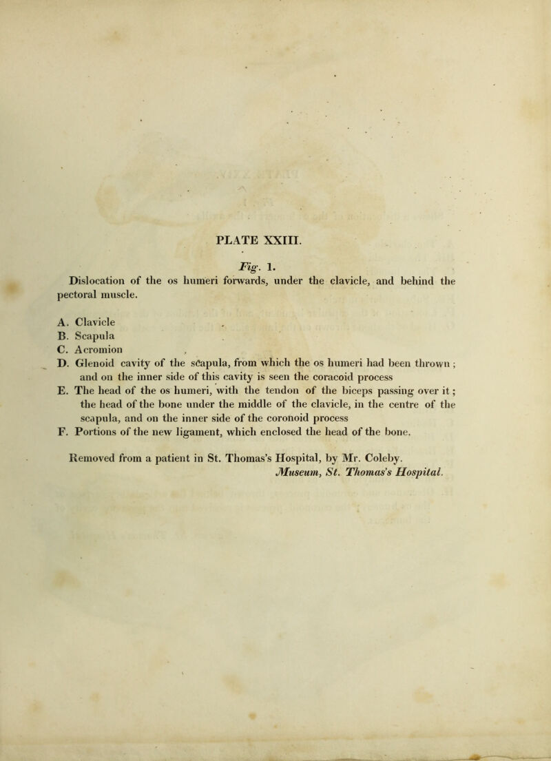 Fig. 1. Dislocation of the os humeri forwards, under the clavicle, and behind the pectoral muscle. A. Clavicle B. Scapula C. Acromion D. Glenoid cavity of the sCapula, from which the os humeri had been thrown ; and on the inner side of this cavity is seen the coracoid process E. The head of the os humeri, with the tendon of the biceps passing over it; the head of the bone under the middle of the clavicle, in the centre of the scapula, and on the inner side of the coronoid process F. Portions of the new ligament, which enclosed the head of the bone. Removed from a patient in St. Thomas’s Hospital, by Mr. Coleby.