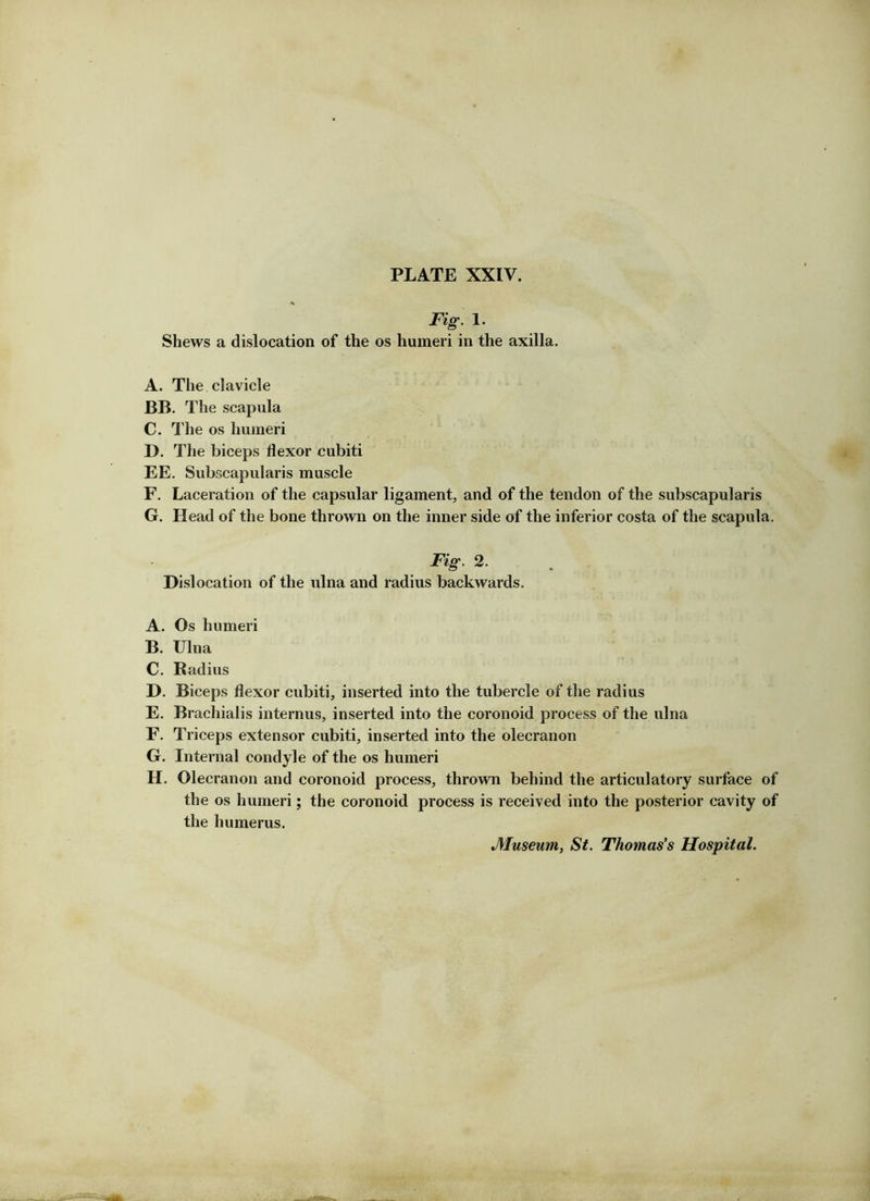 Fig. 1. Shews a dislocation of the os humeri in the axilla. A. The clavicle BB. The scapula C. The os humeri D. The biceps flexor cubiti EE. Subscapularis muscle F. Laceration of the capsular ligament, and of the tendon of the subscapularis G. Head of the bone thrown on the inner side of the inferior costa of the scapula. Fig. 2. Dislocation of the ulna and radius backwards. A. Os humeri B. Ulna C. Radius D. Biceps flexor cubiti, inserted into the tubercle of the radius E. Brachialis internus, inserted into the coronoid process of the ulna F. Triceps extensor cubiti, inserted into the olecranon G. Internal condyle of the os humeri H. Olecranon and coronoid process, thrown behind the articulatory surface of the os humeri; the coronoid process is received into the posterior cavity of the humerus.